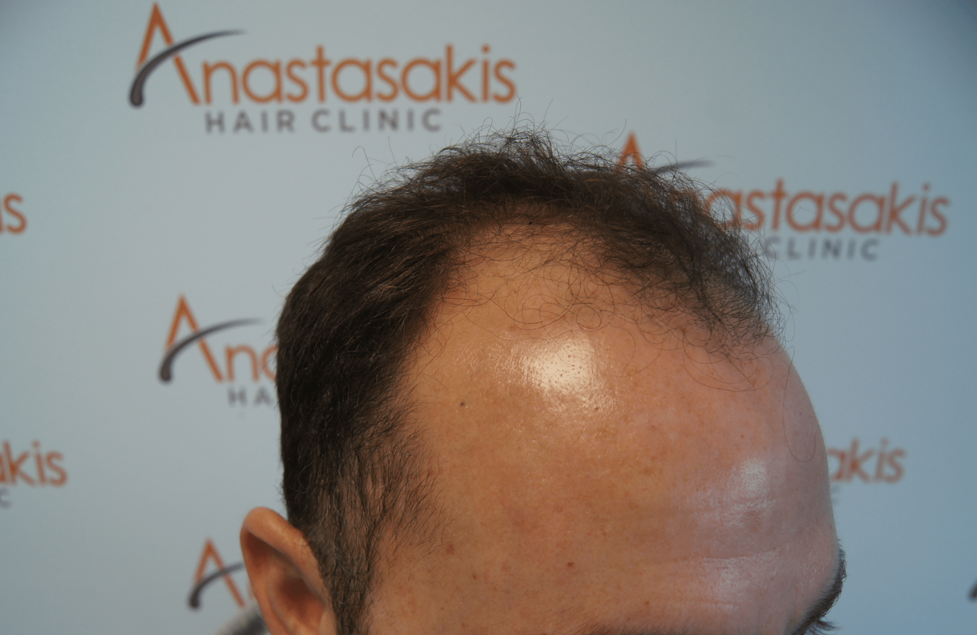 hair transplant patient result with 3500 fus before - side2