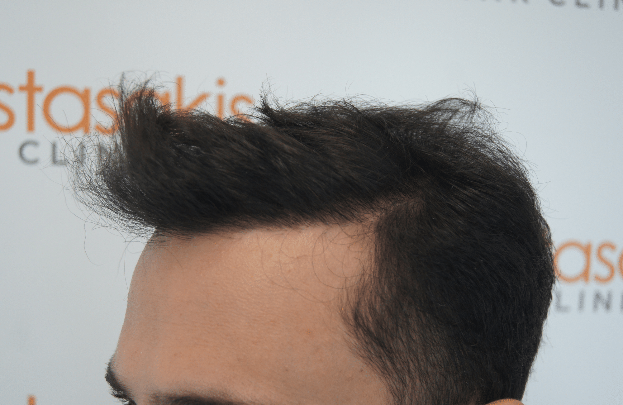 hair transplant patient result with 1800 fus after and 500 fus in beard - side1