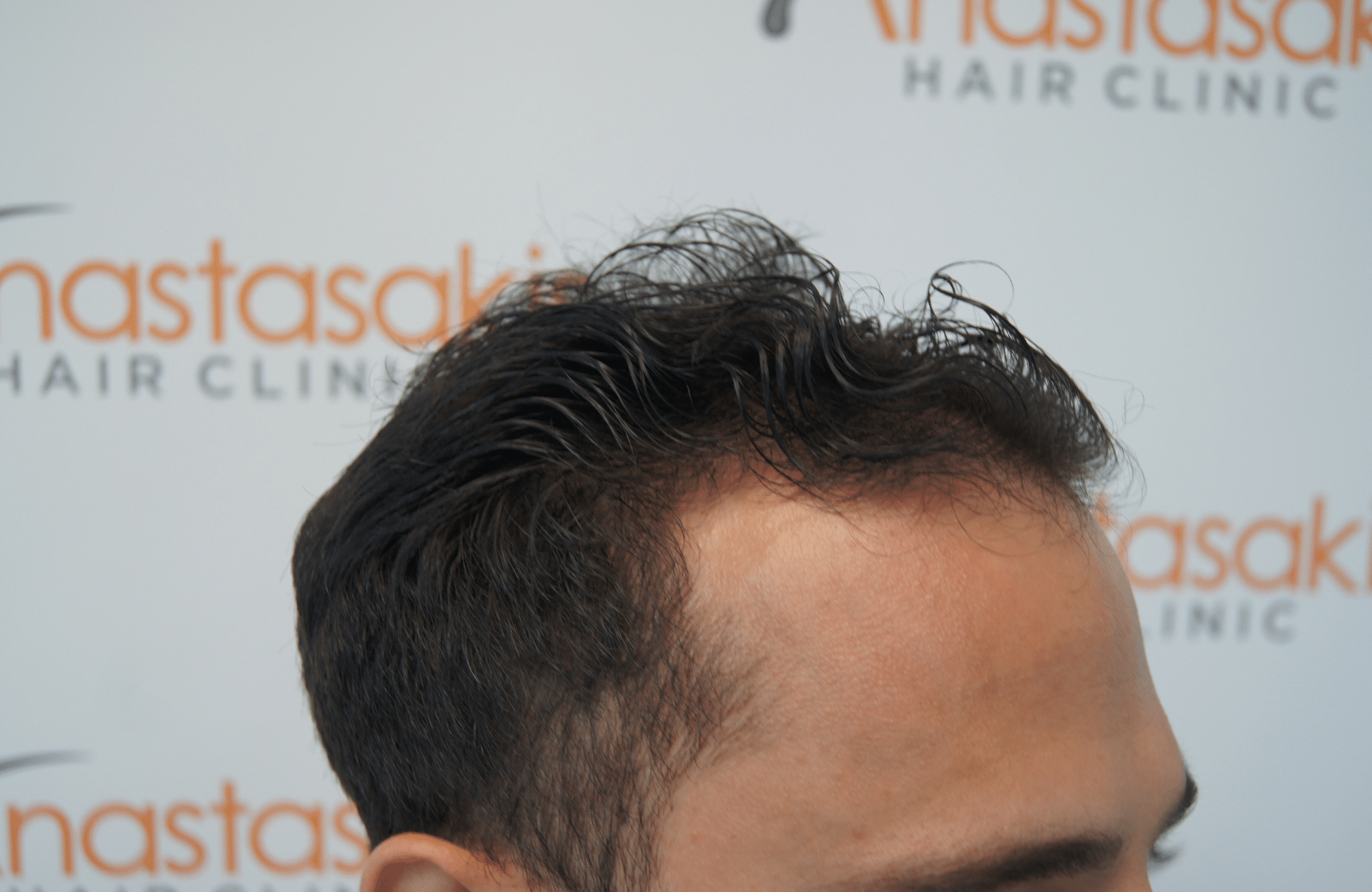 hair transplant patient result with 1800 fus before and 500 fus in beard - side2