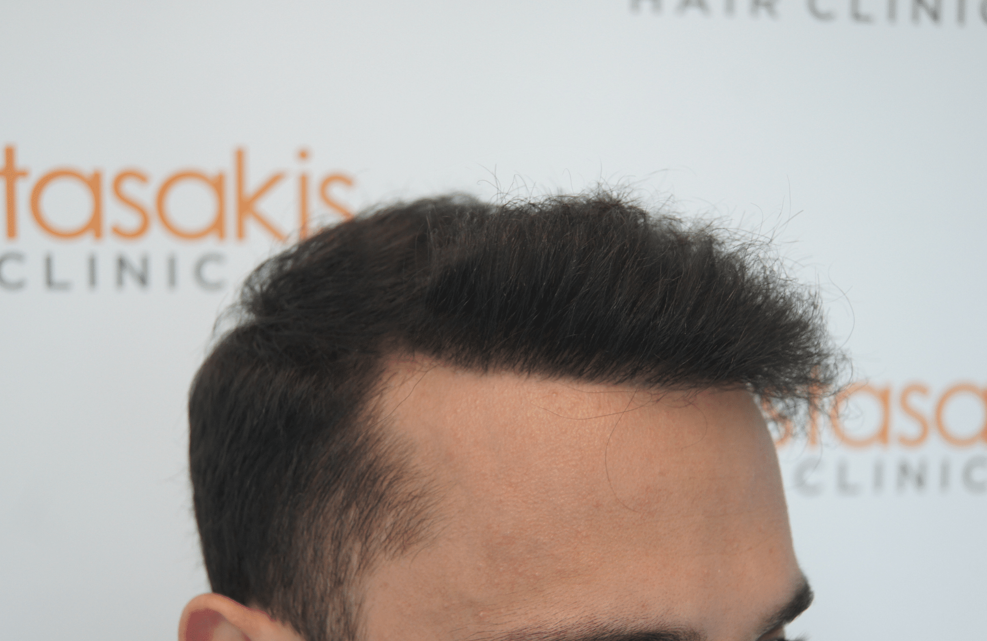 hair transplant patient result with 1800 fus after and 500 fus in beard - side2