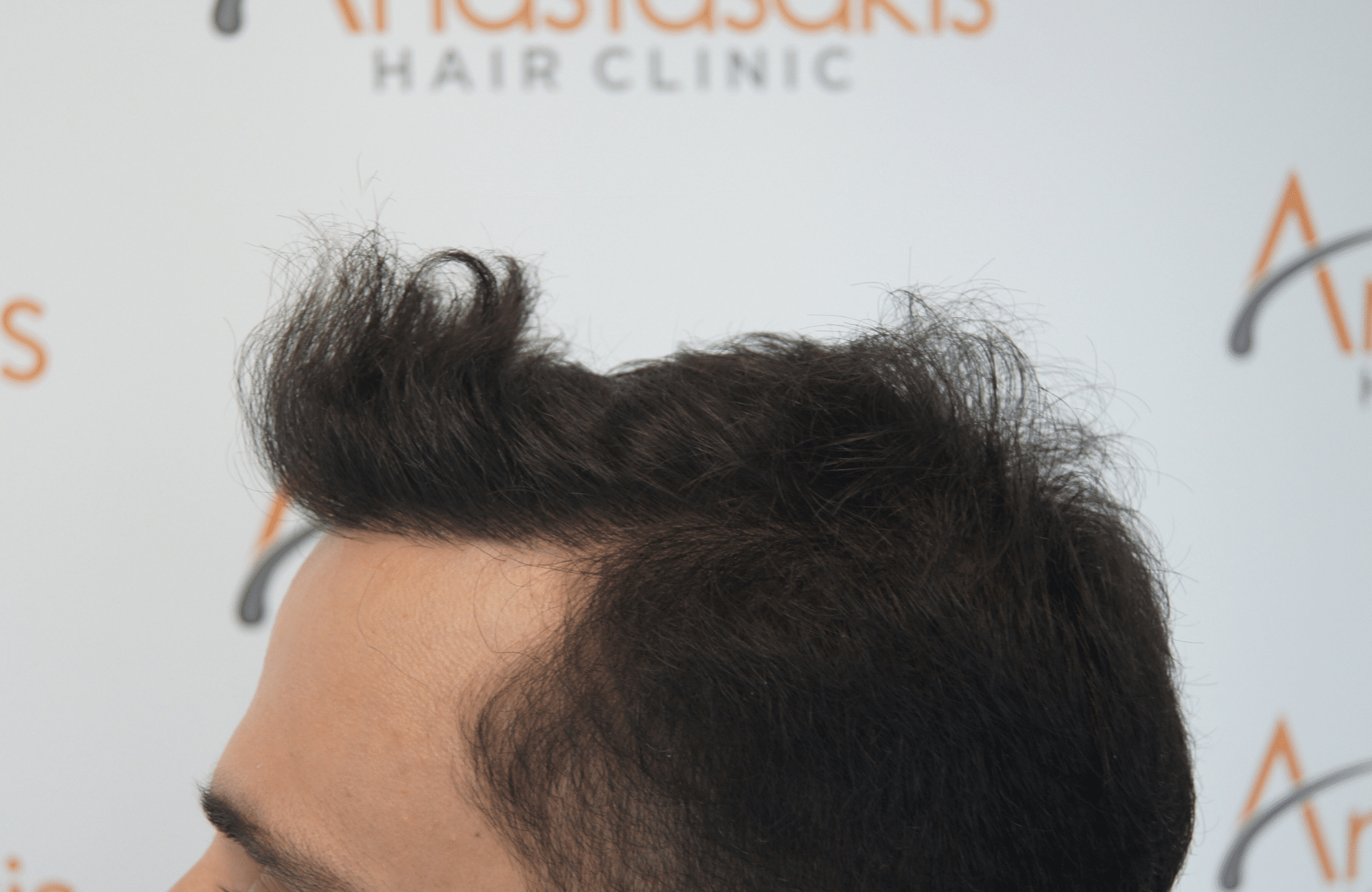 hair transplant patient result with 1800 fus after and 500 fus in beard - side3