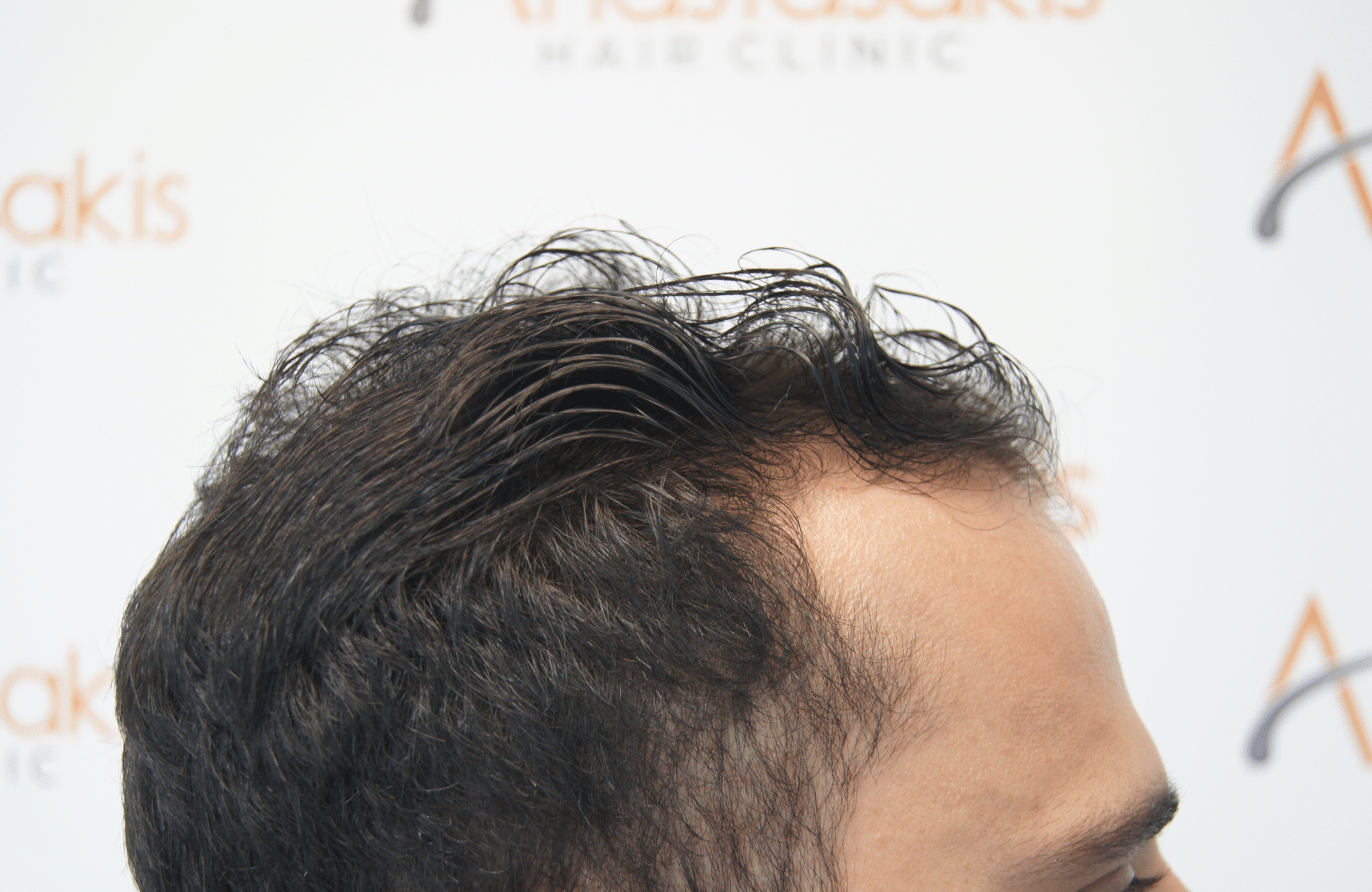 hair transplant patient result with 1800 fus before and 500 fus in beard - side4