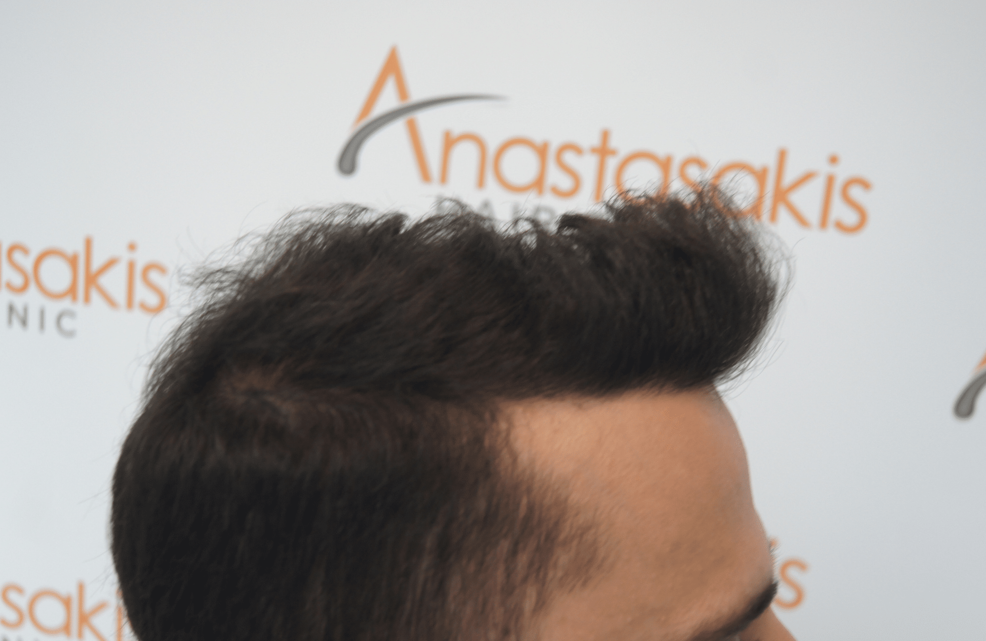 hair transplant patient result with 1800 fus after and 500 fus in beard - side4