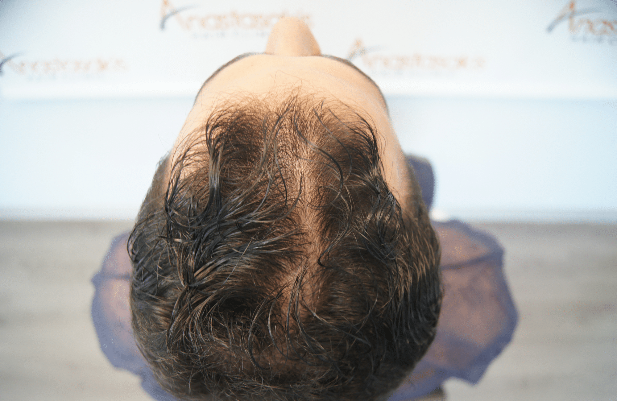 hair transplant patient result with 1800 fus before and 500 fus in beard - back
