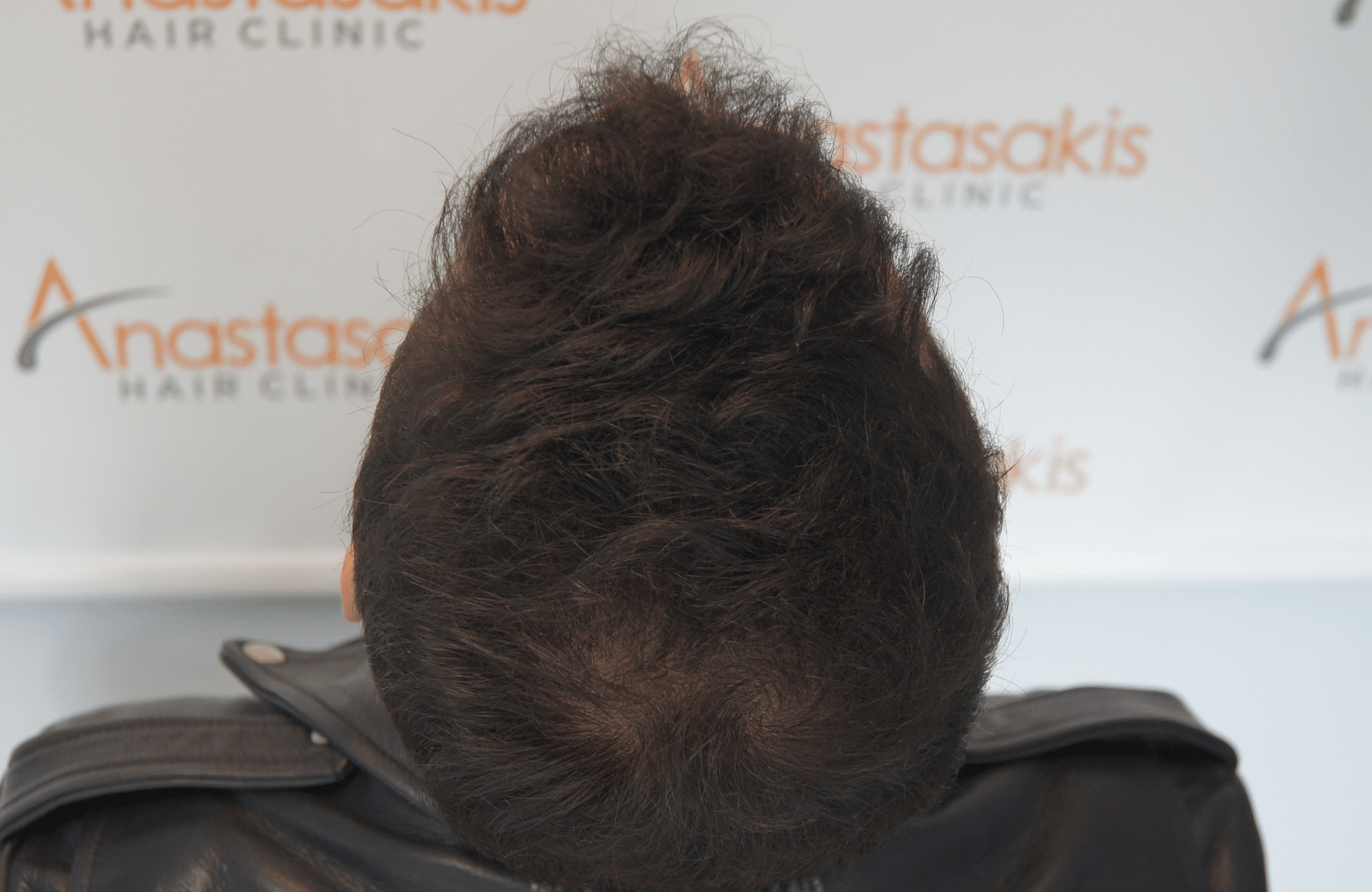 hair transplant patient result with 1800 fus after and 500 fus in beard - back
