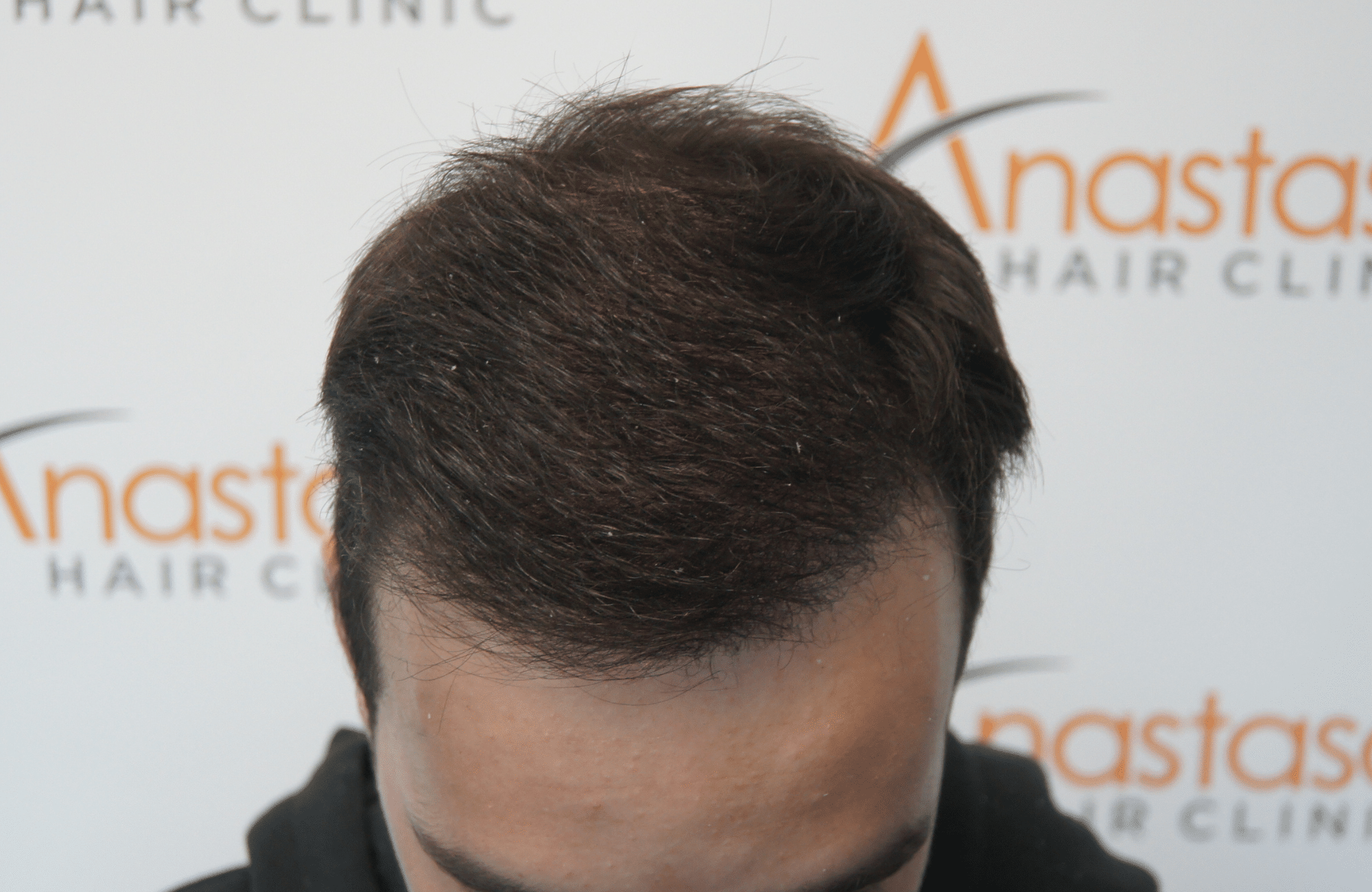 hair transplant patient result with 2500 fus after - up