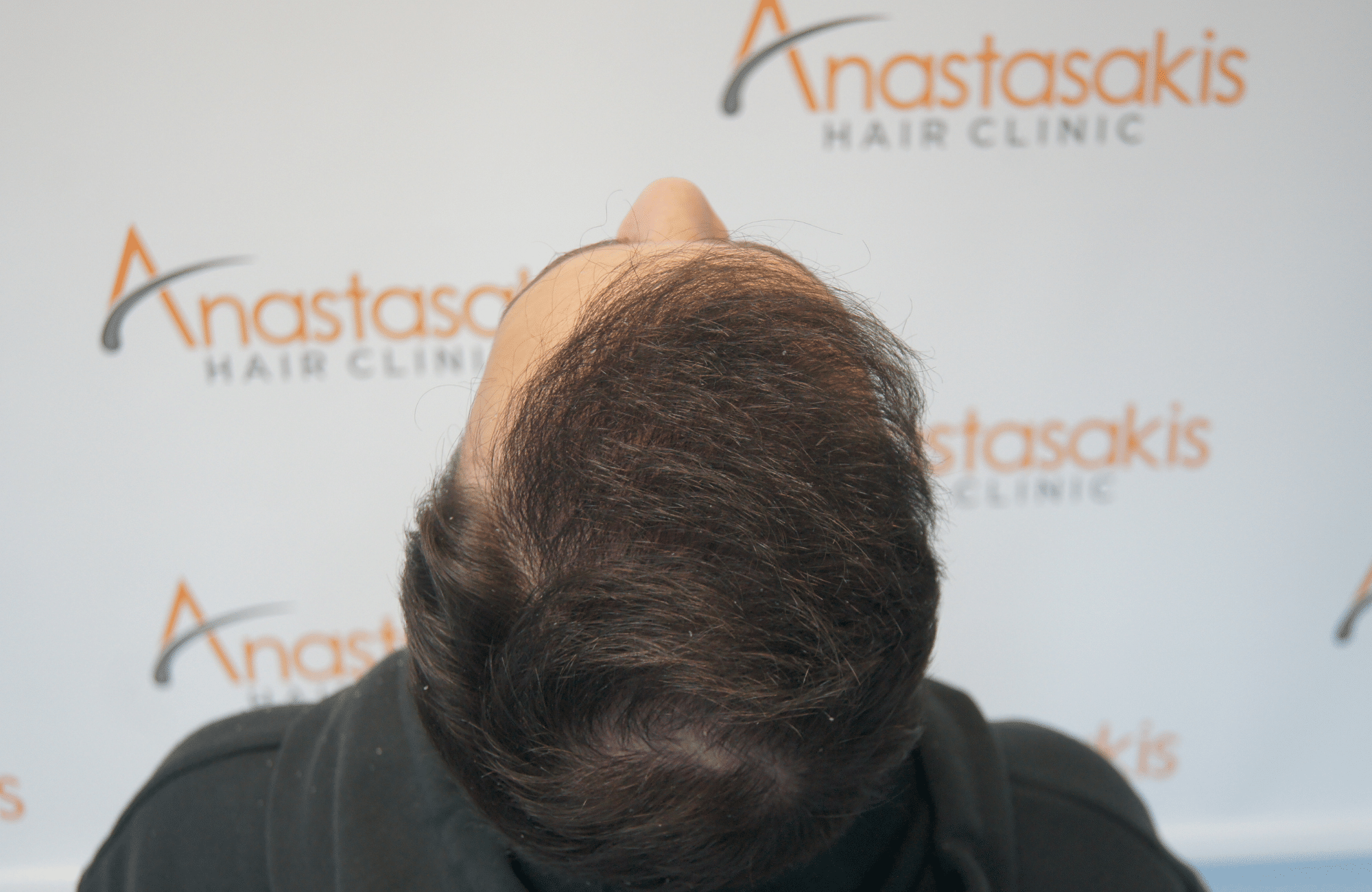 hair transplant patient result with 2500 fus after - back