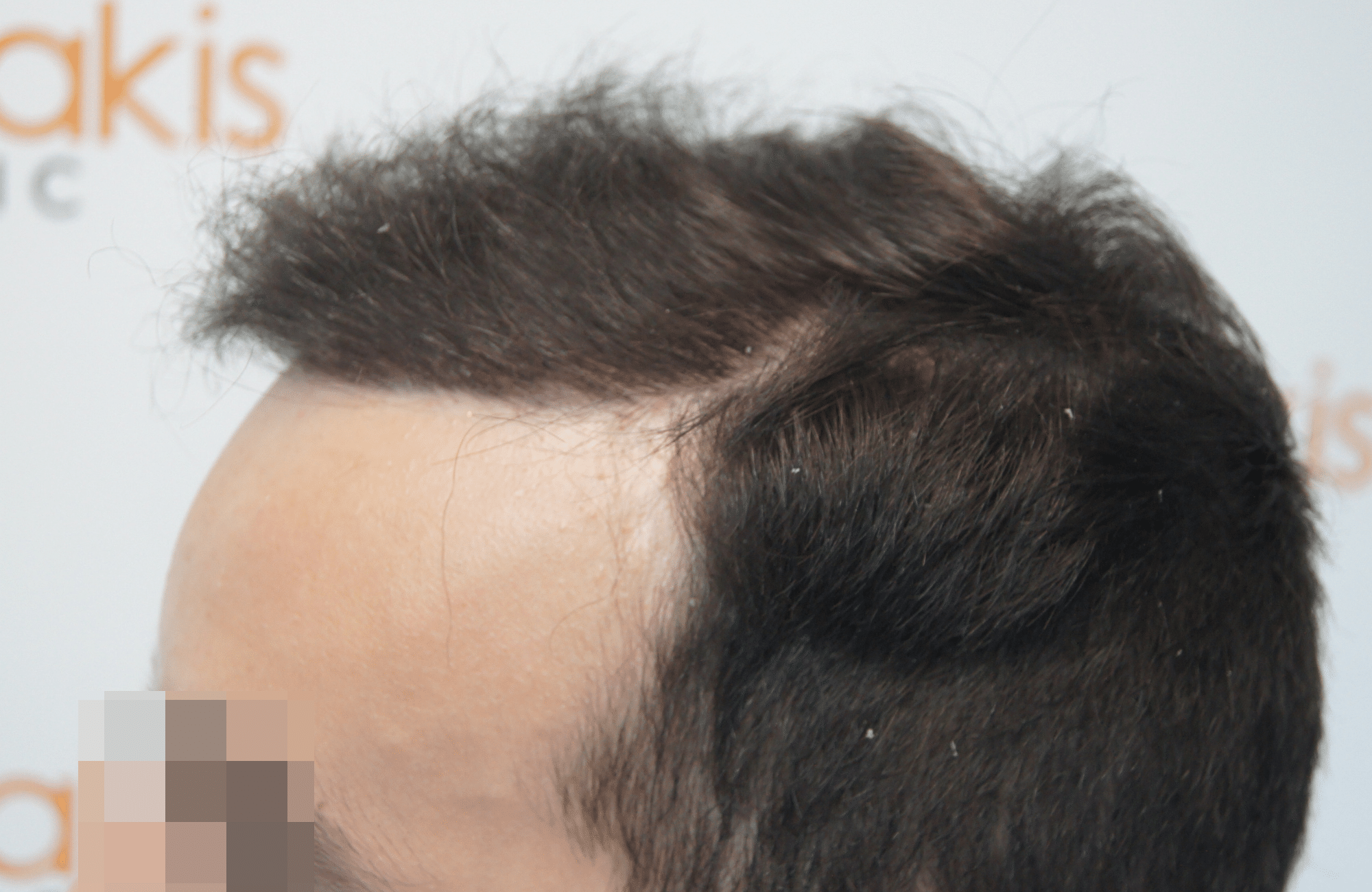 hair transplant patient result with 2500 fus after - side2