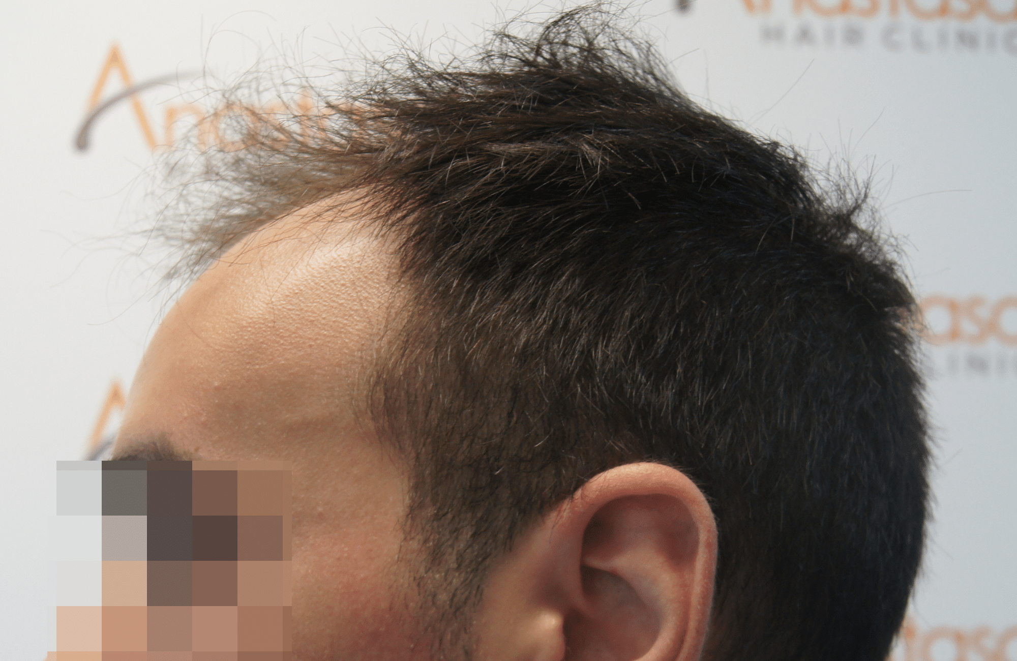 hair transplant patient result with 2500 fus before - side2