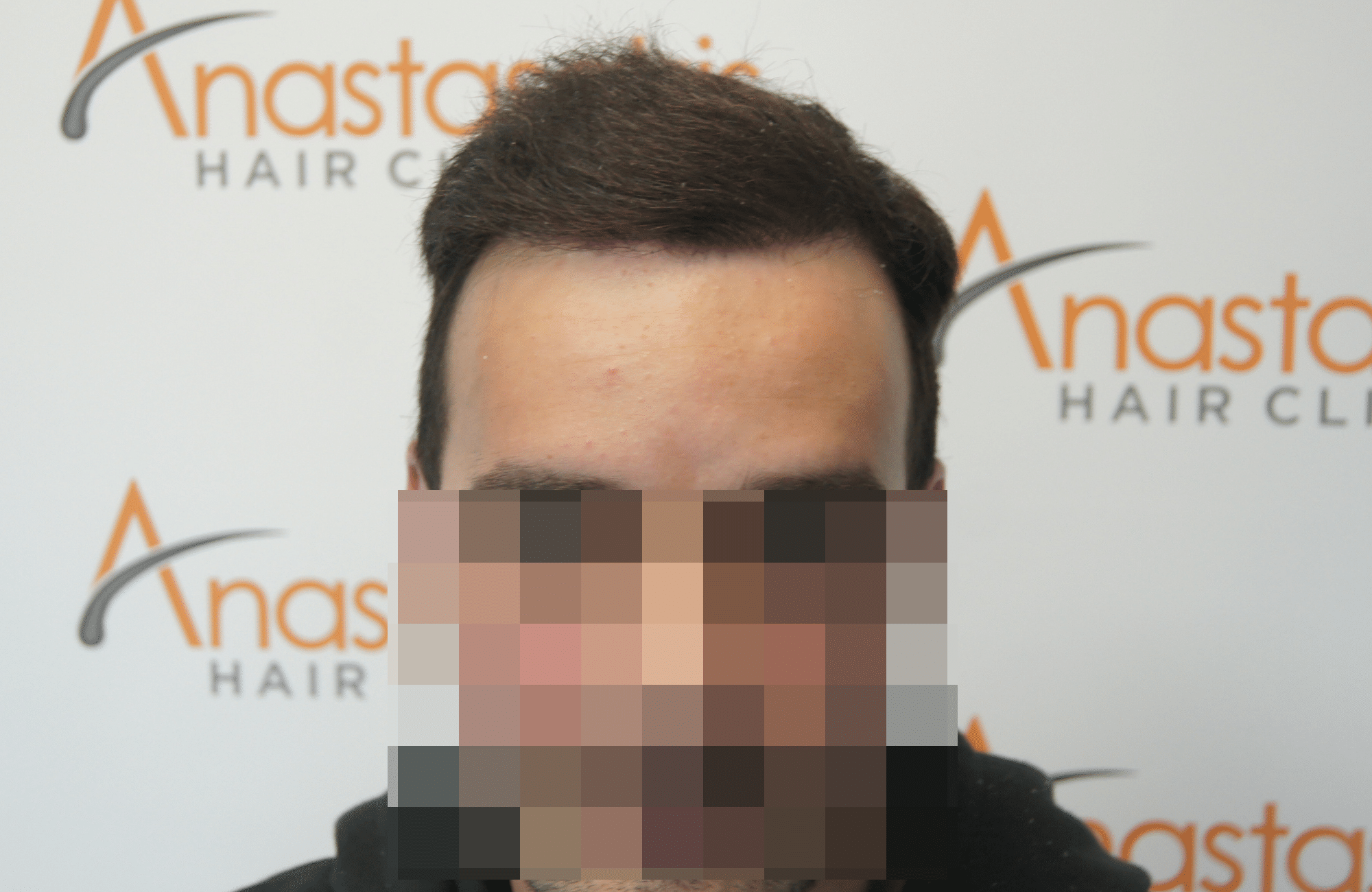 hair transplant patient result with 2500 fus after - fullface
