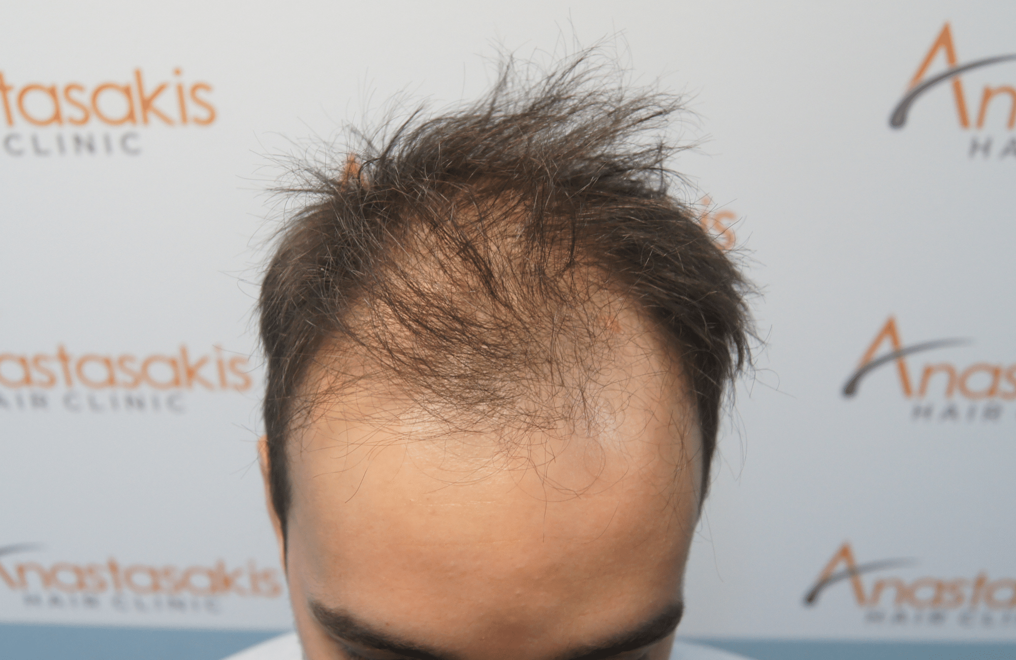 hair transplant patient result with 2500 fus before - up