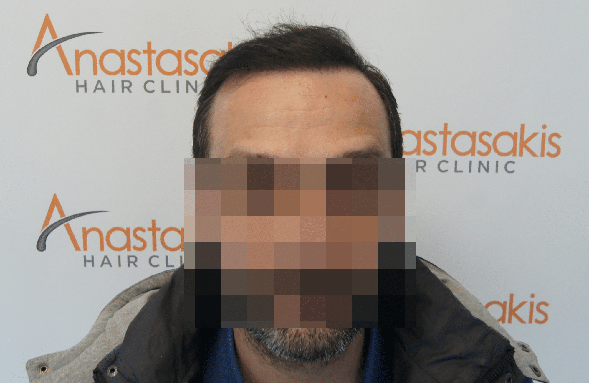 hair transplant patient result with 2500 fus after - fullface