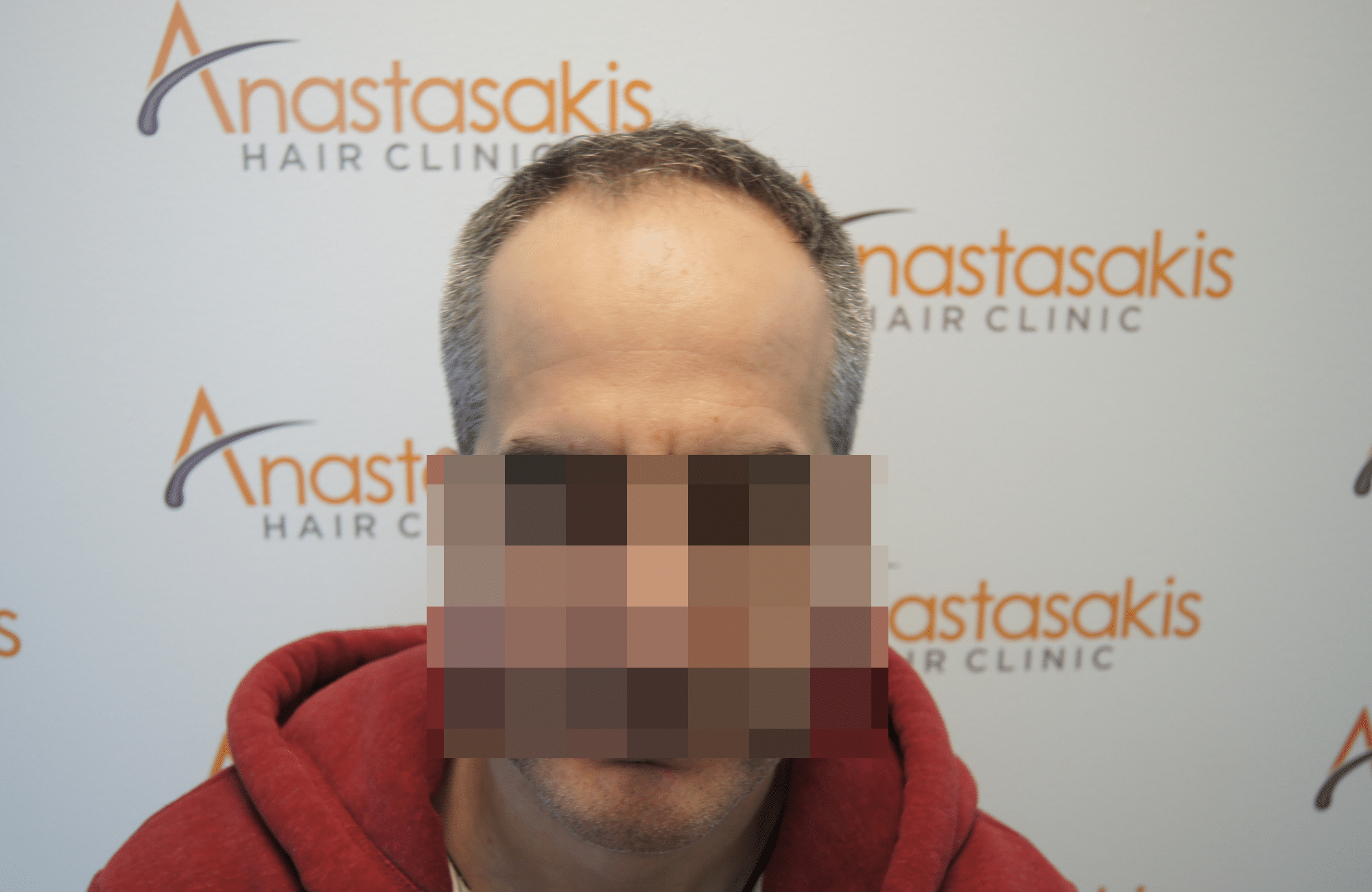 hair transplant patient result with 2600 fus before - fullface