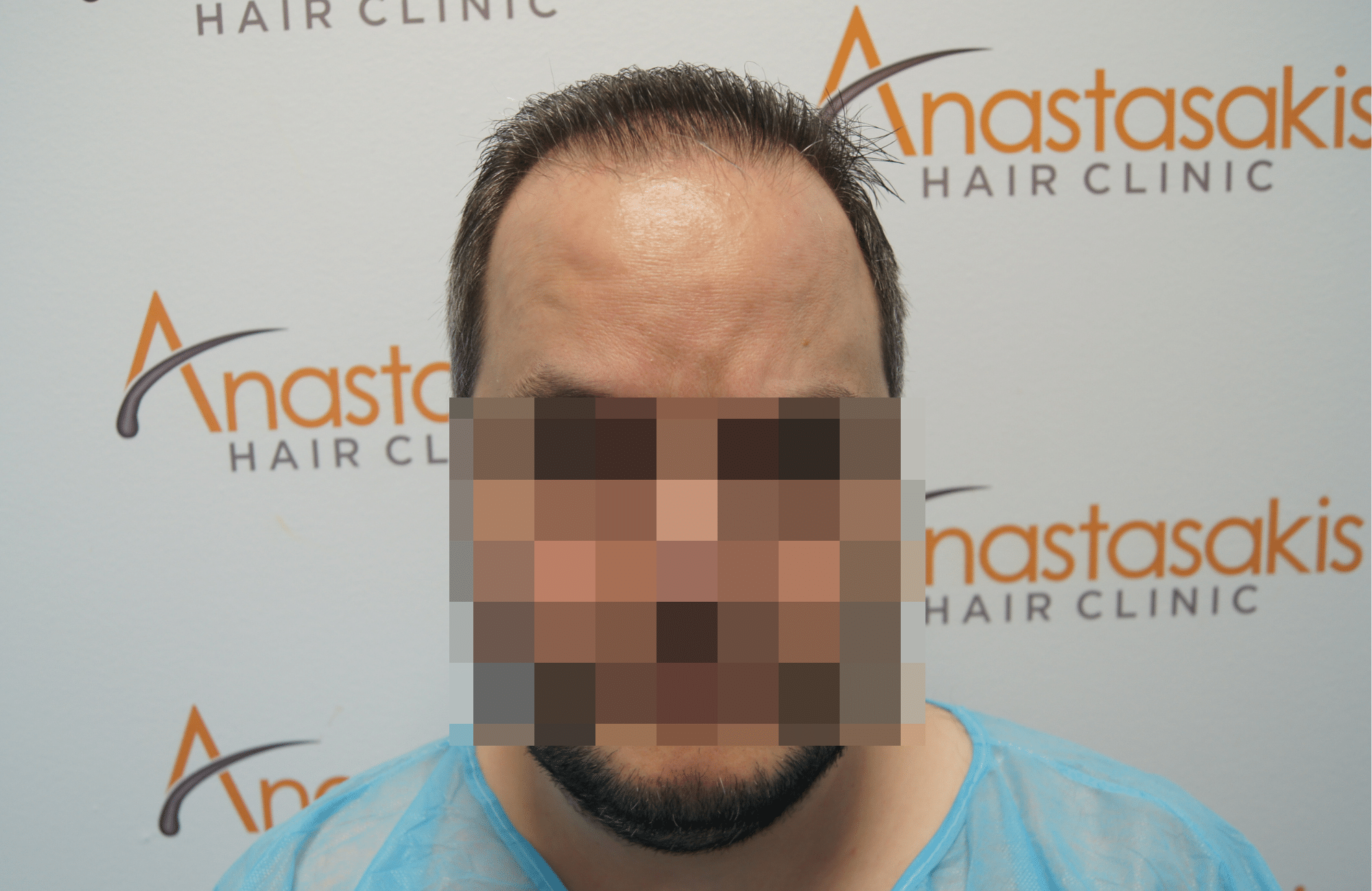 hair transplant patient result with 3500 fus before - fullface