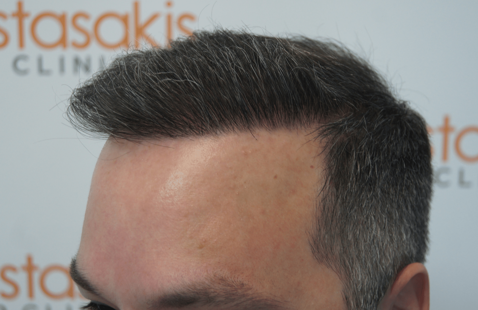 hair transplant patient result with 3500 fus after - side1