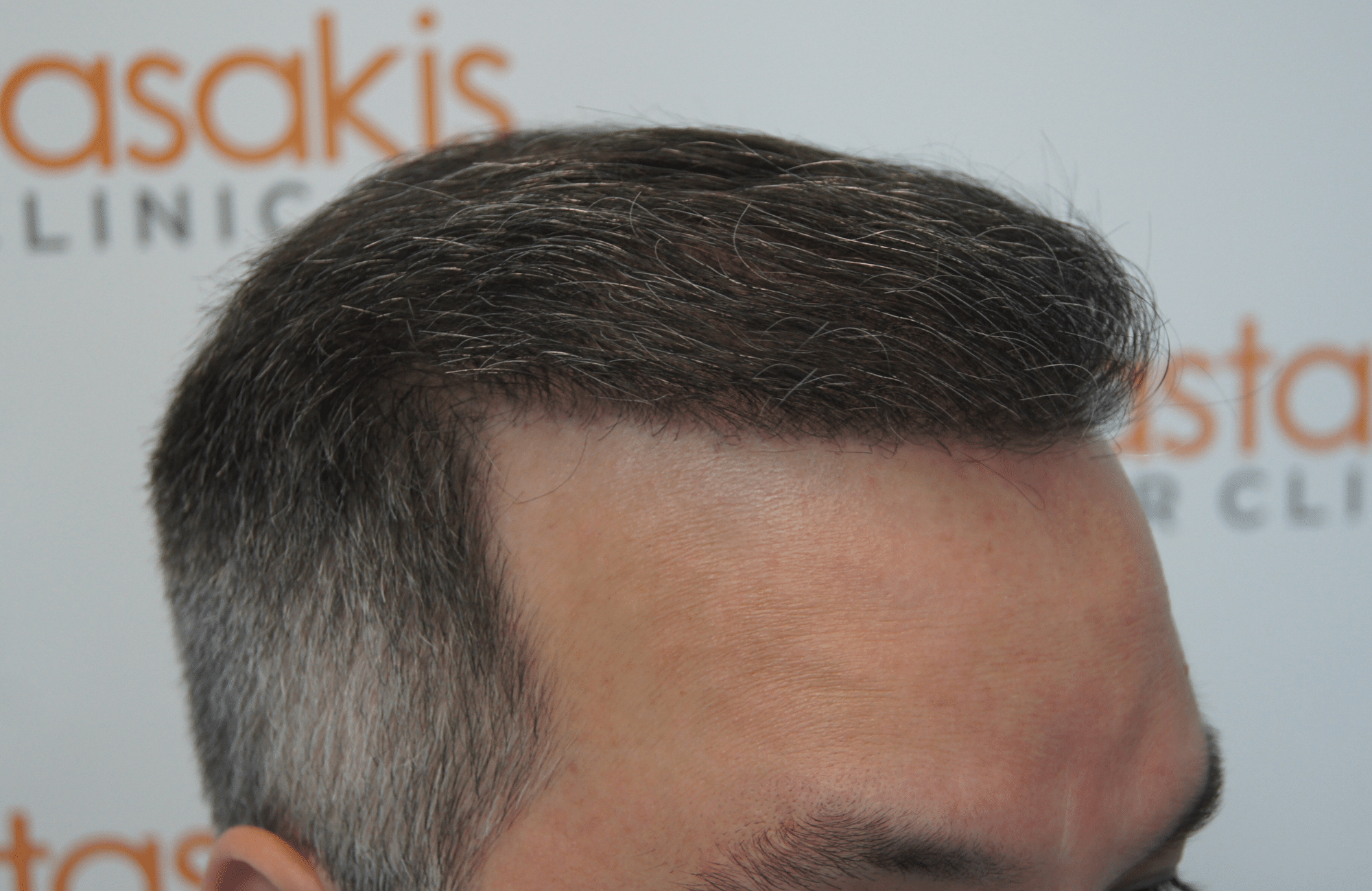 hair transplant patient result with 3500 fus after - side2