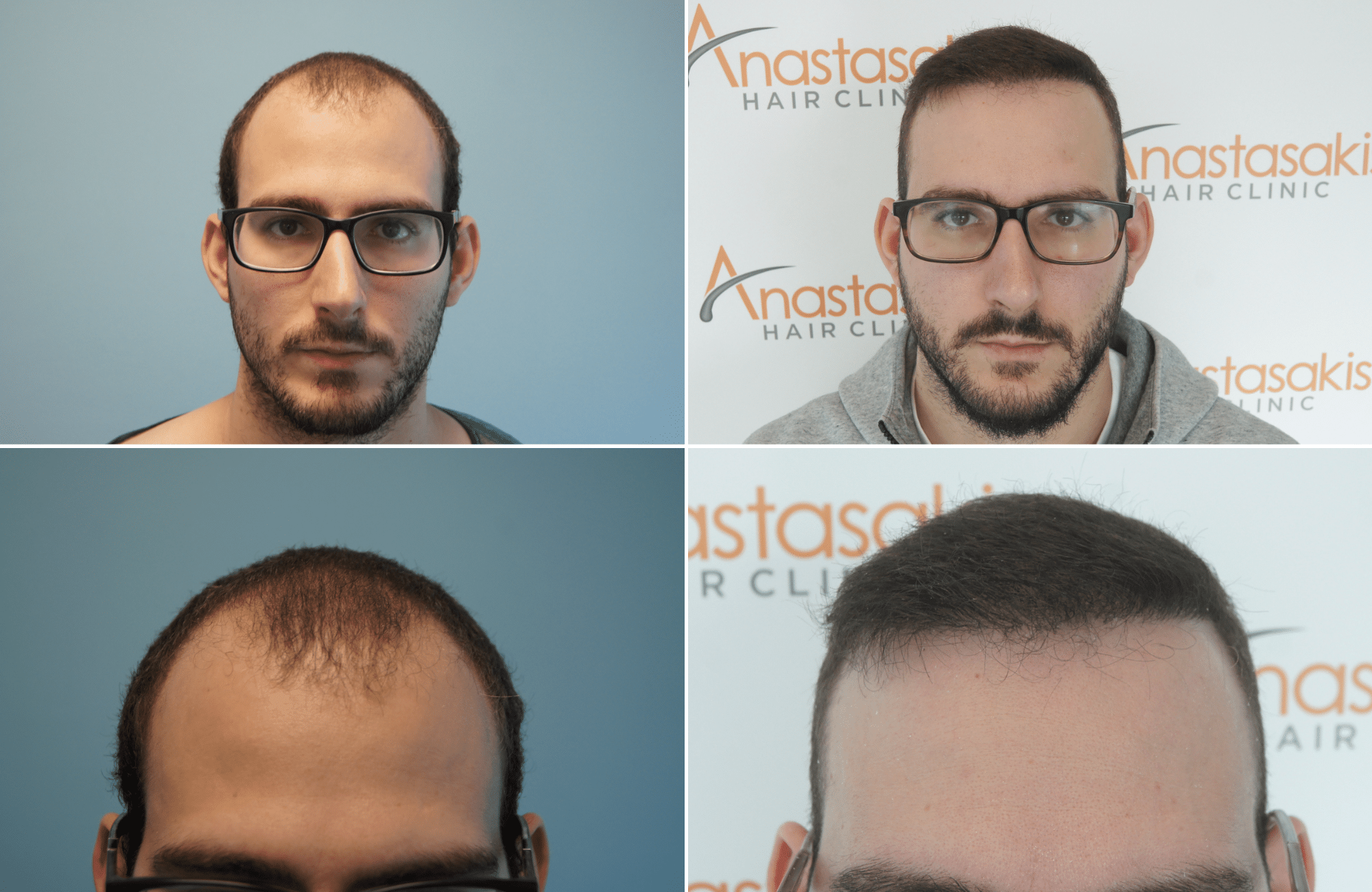 https://anastasakishairclinic.com/portfolio/hair-transplant-result-anastasakis-hair-clinic-380/