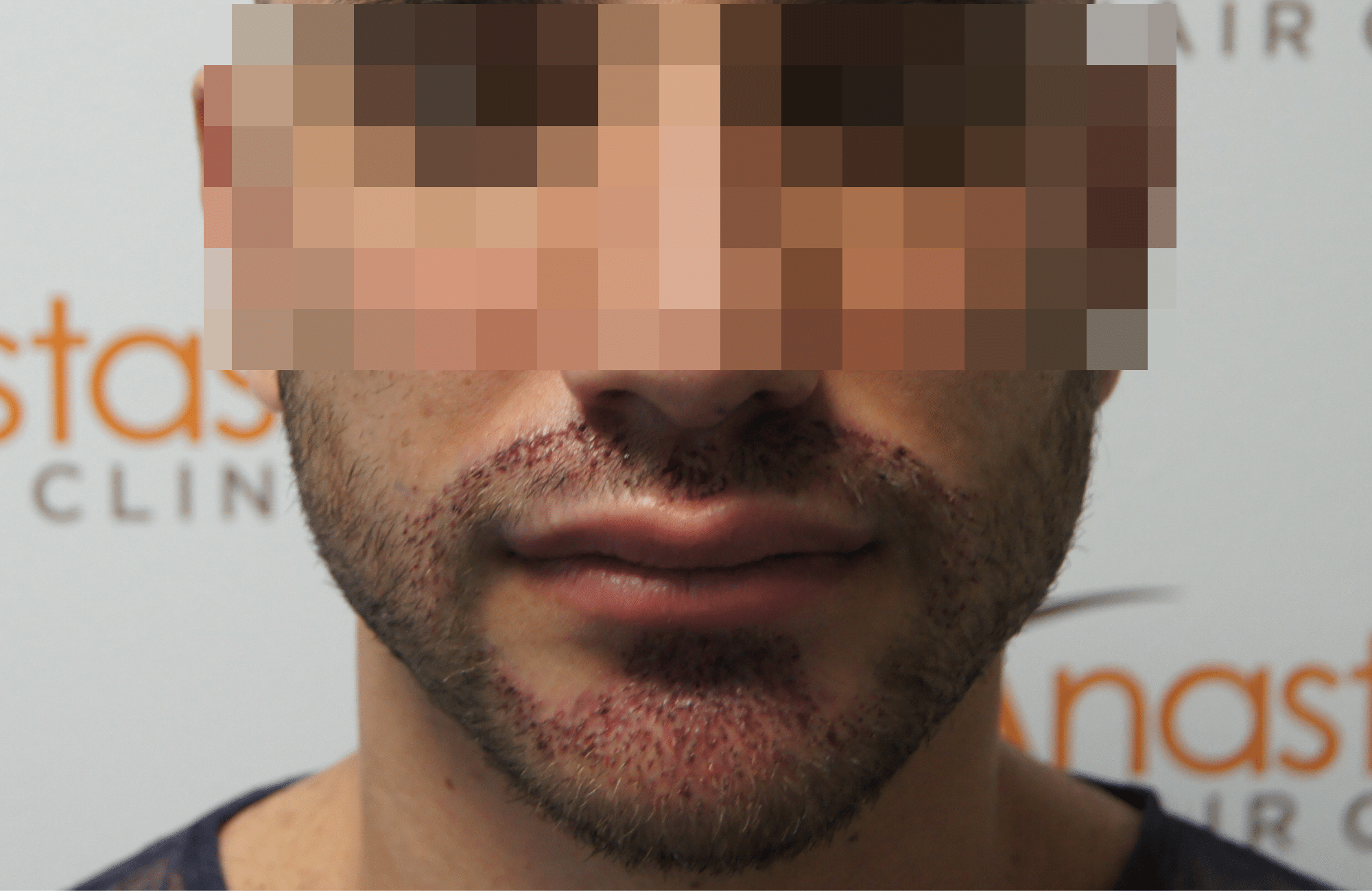 hair transplant patient result with 1800 fus right after and 500 fus in beard - beard
