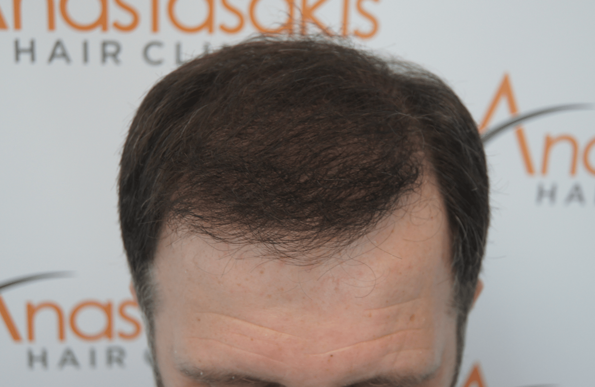 hair transplant patient result with 3500 fus after - up