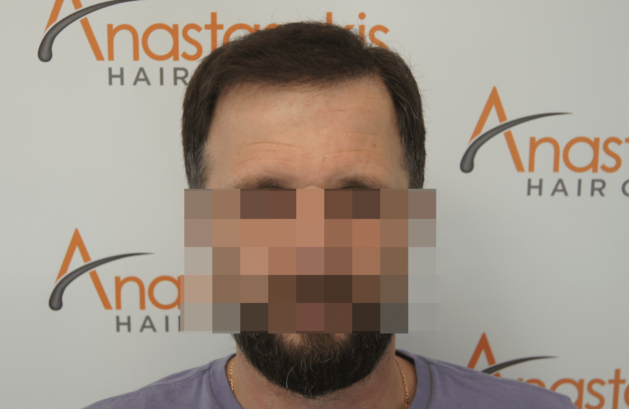 hair transplant patient result with 3500 fus after - fullface