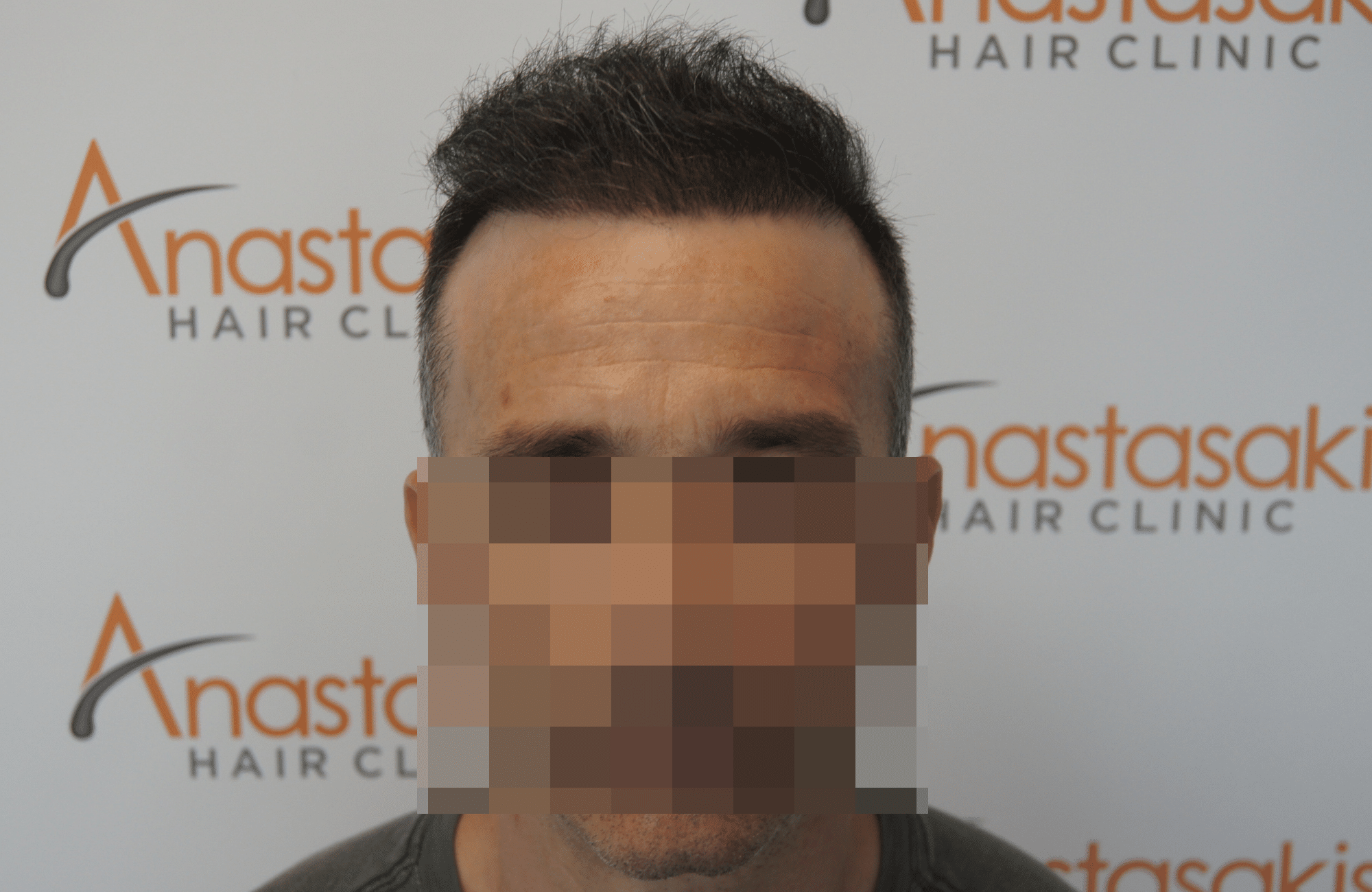 hair transplant patient result with 3500 fus after - fullface