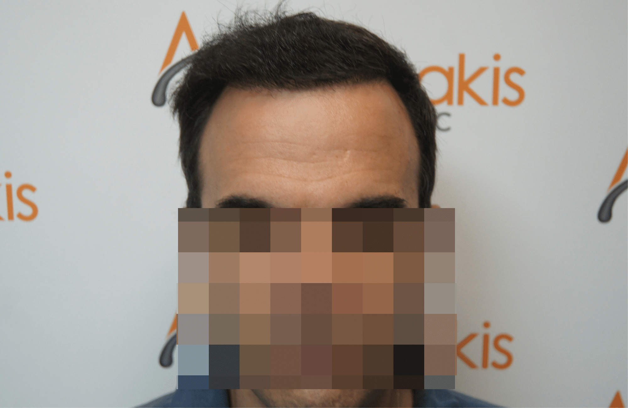 hair transplant patient result with 2500 fus after - fullface