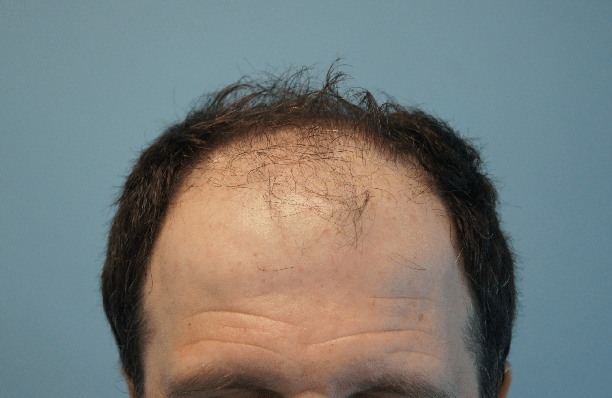 hair transplant patient result with 3500 fus before - hairline
