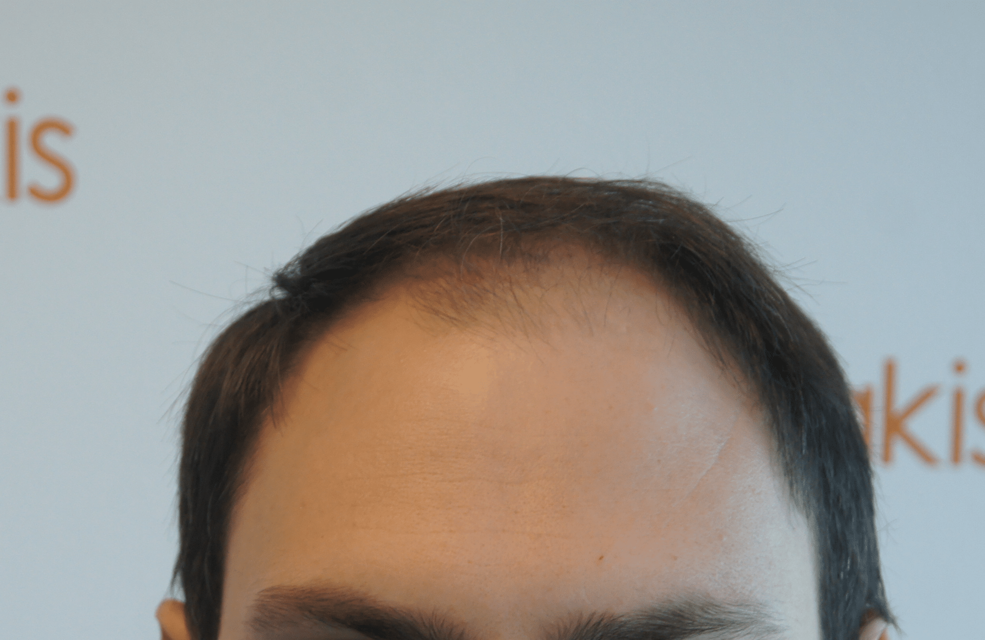 hair transplant patient result with 2700 fus before - hairline