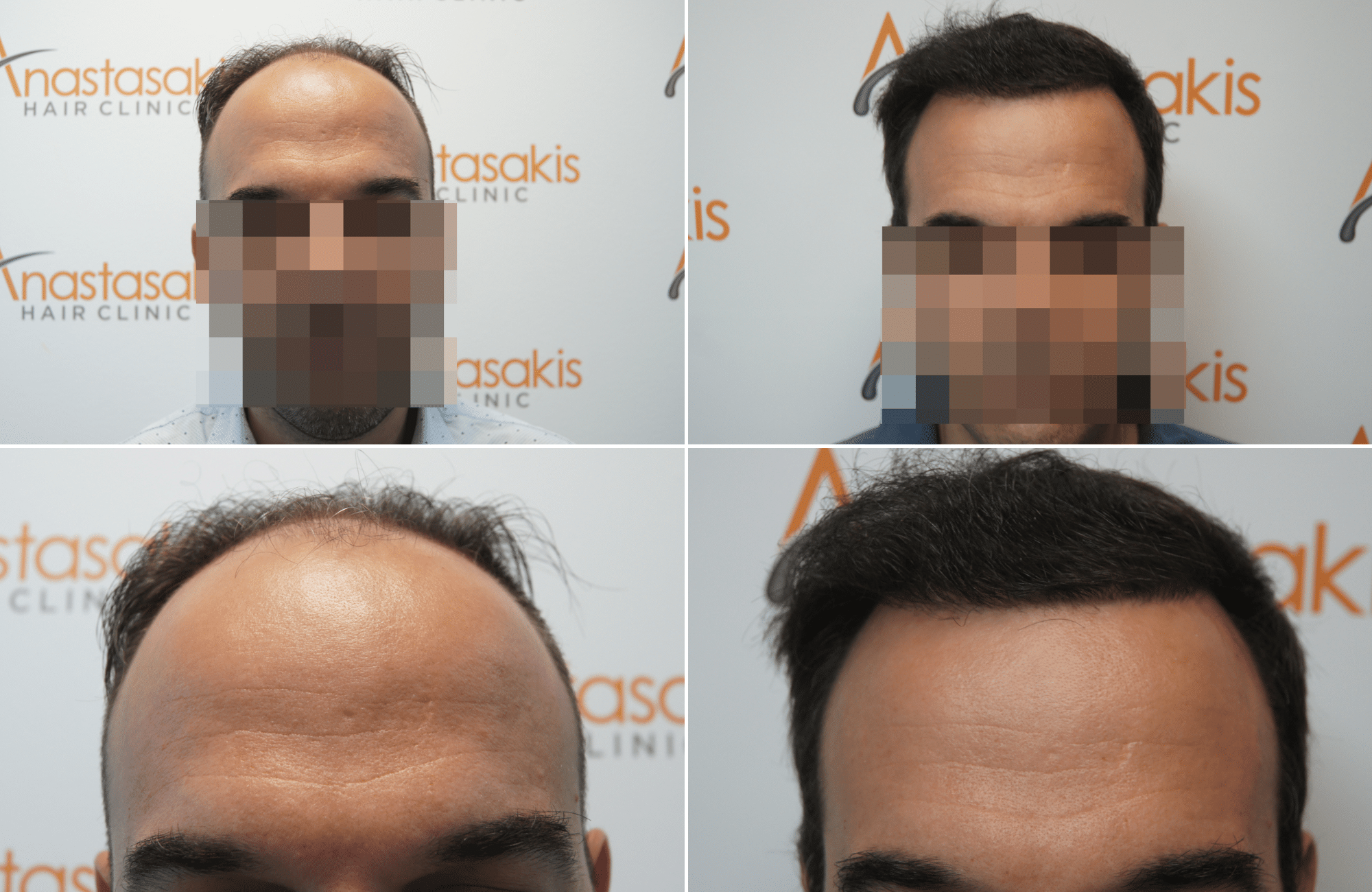 https://anastasakishairclinic.com/portfolio/hair-transplant-result-anastasakis-hair-clinic-385/