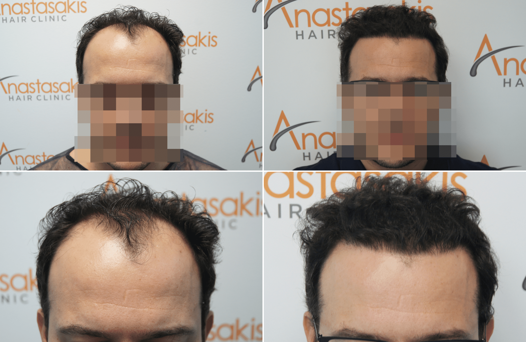 https://anastasakishairclinic.com/portfolio/hair-transplant-result-anastasakis-hair-clinic-386/