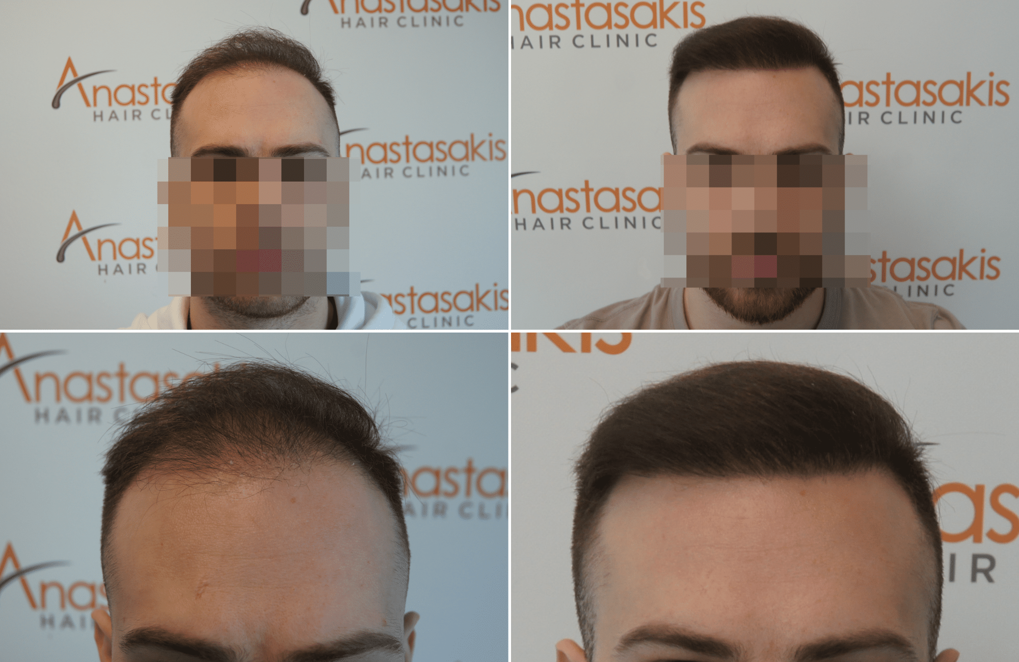 https://anastasakishairclinic.com/portfolio/hair-transplant-result-anastasakis-hair-clinic-388/