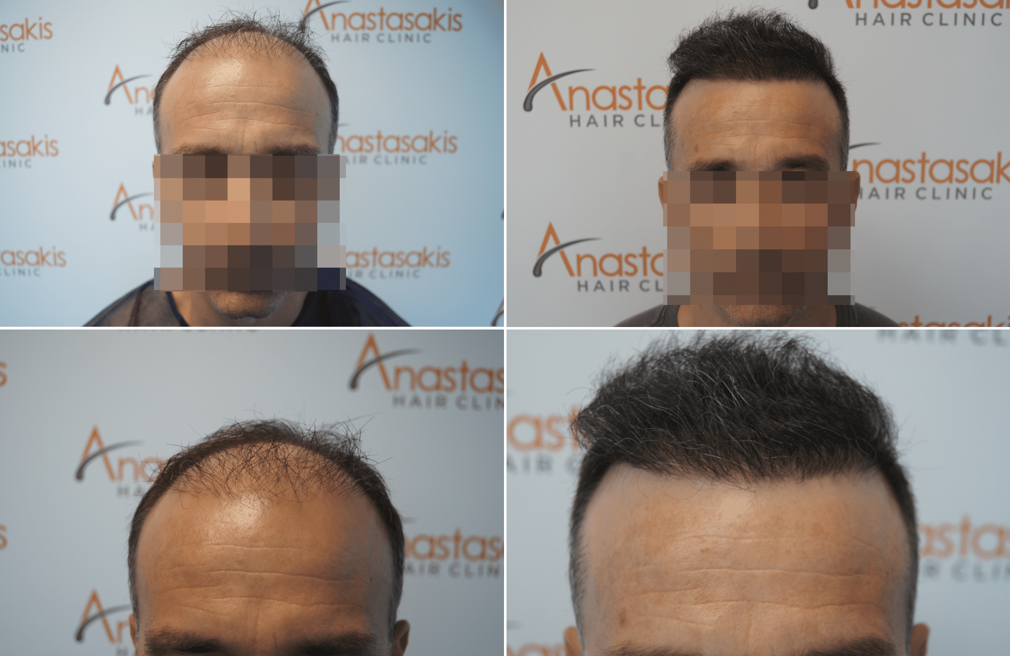 https://anastasakishairclinic.com/portfolio/hair-transplant-result-anastasakis-hair-clinic-389/