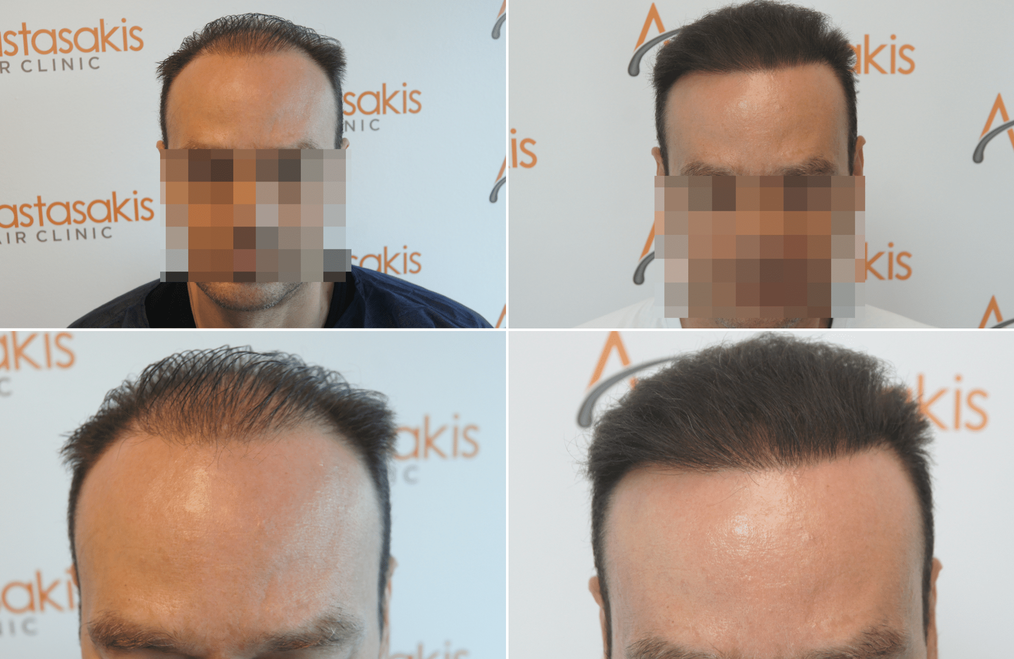 https://anastasakishairclinic.com/portfolio/hair-transplant-result-anastasakis-hair-clinic-390/
