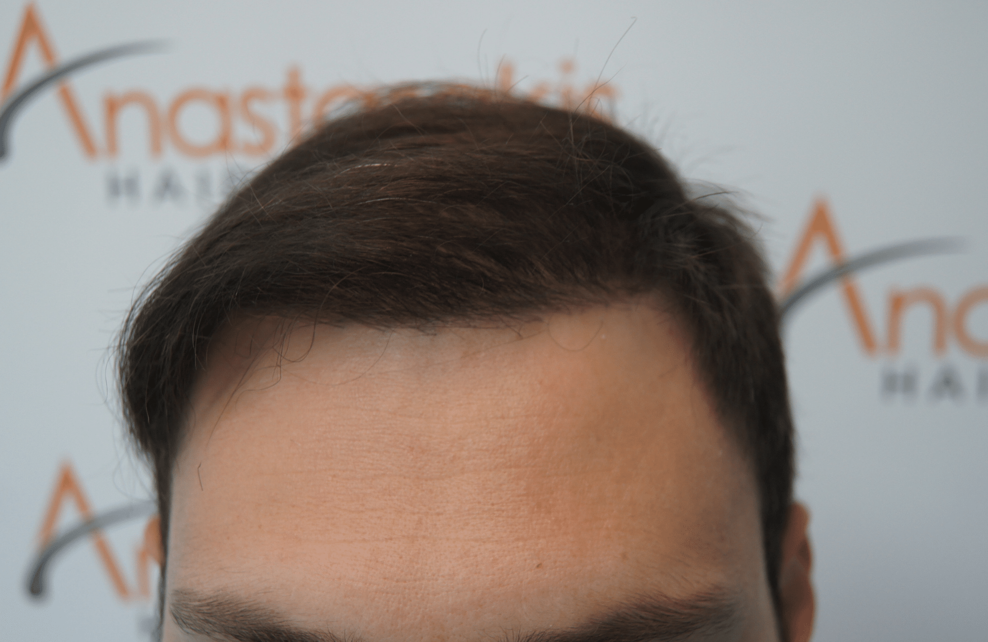 hair transplant patient result with 2700 fus after - hairline