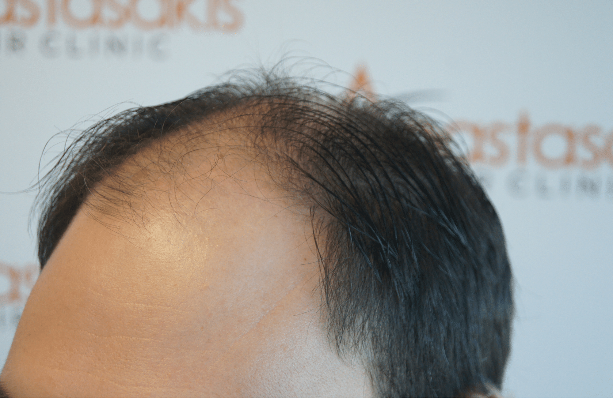 hair transplant patient result with 2700 fus before - side1