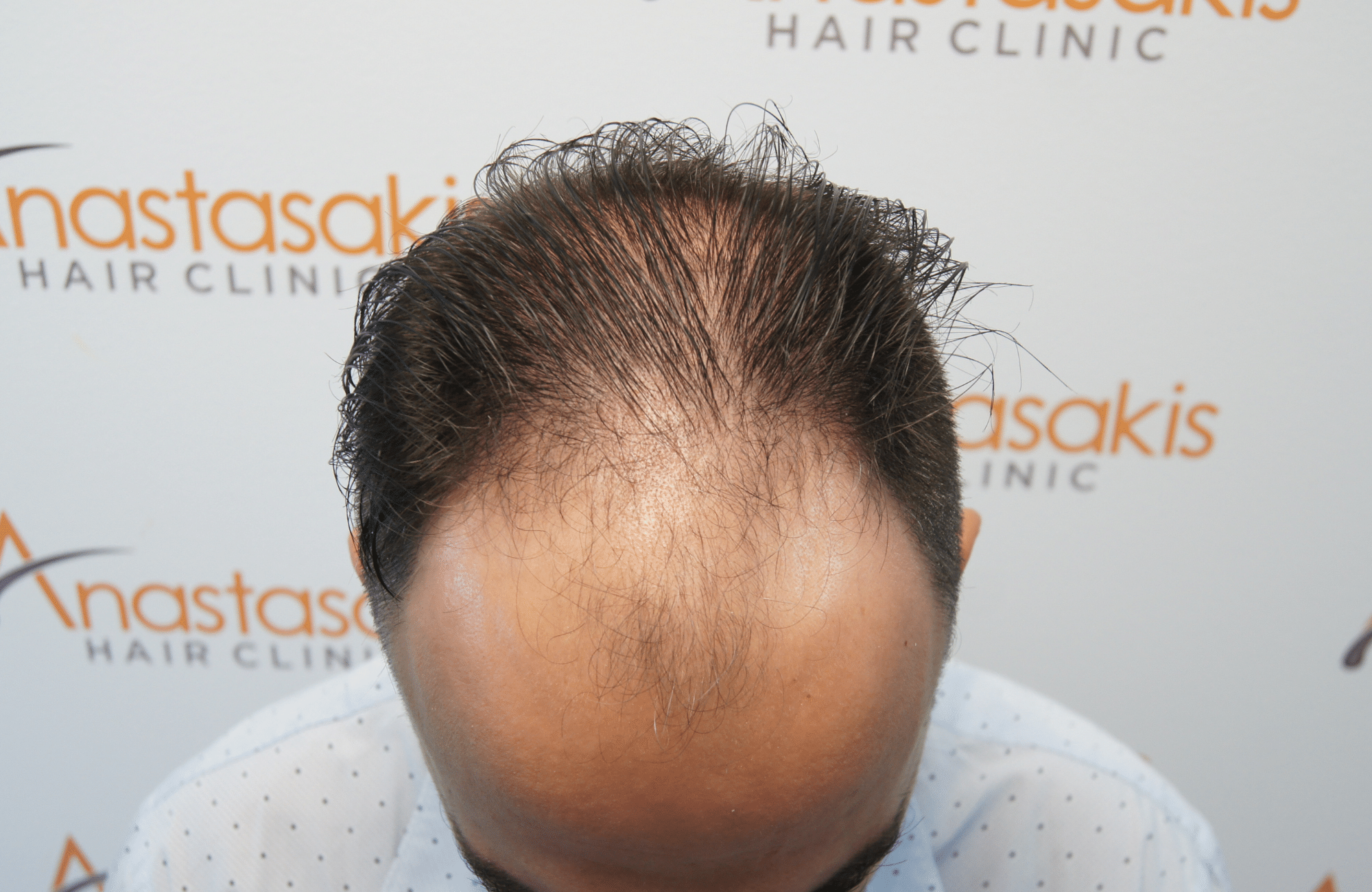 hair transplant patient result with 2500 fus before - frontal
