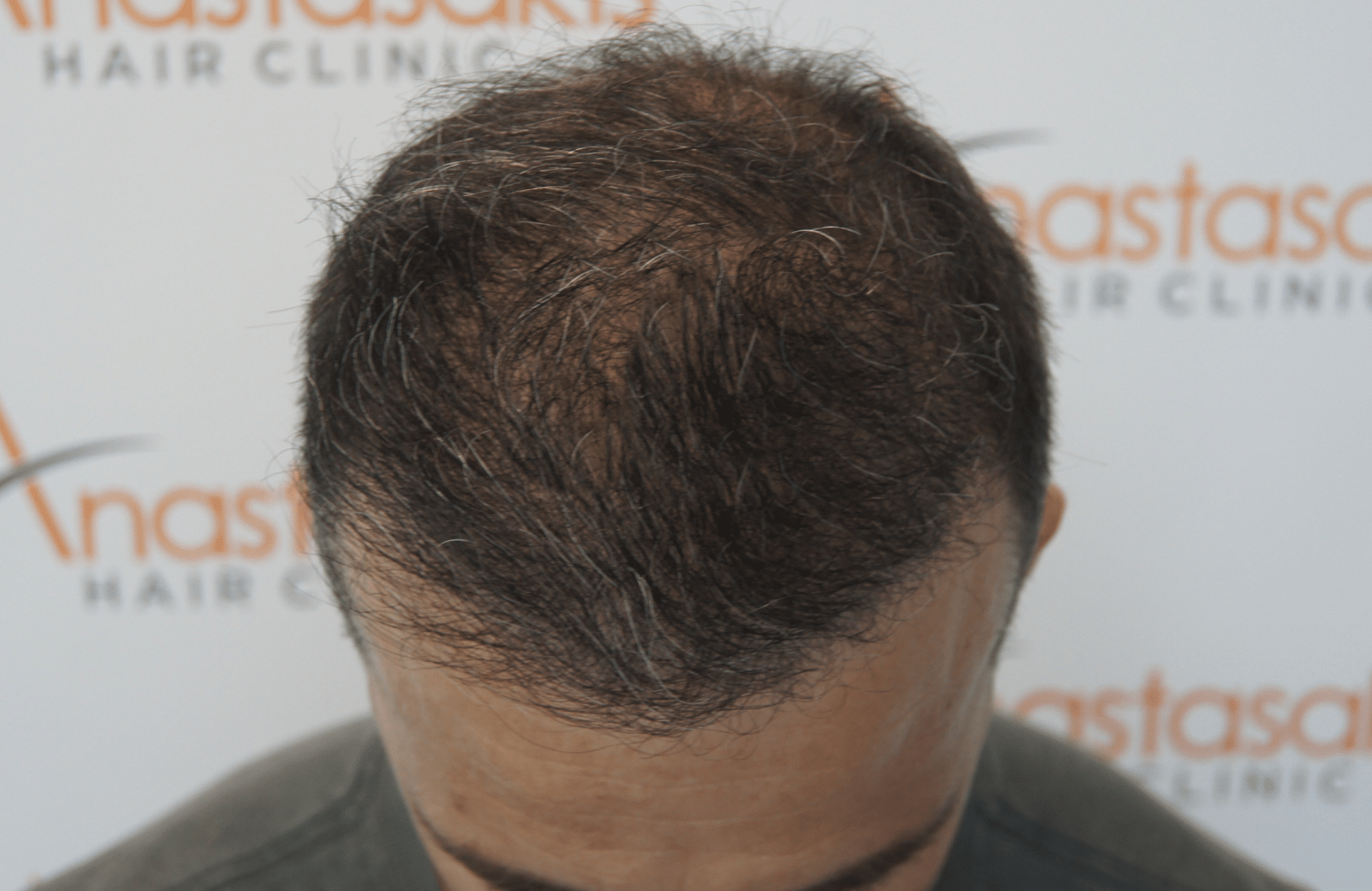 hair transplant patient result with 3500 fus after - frontal