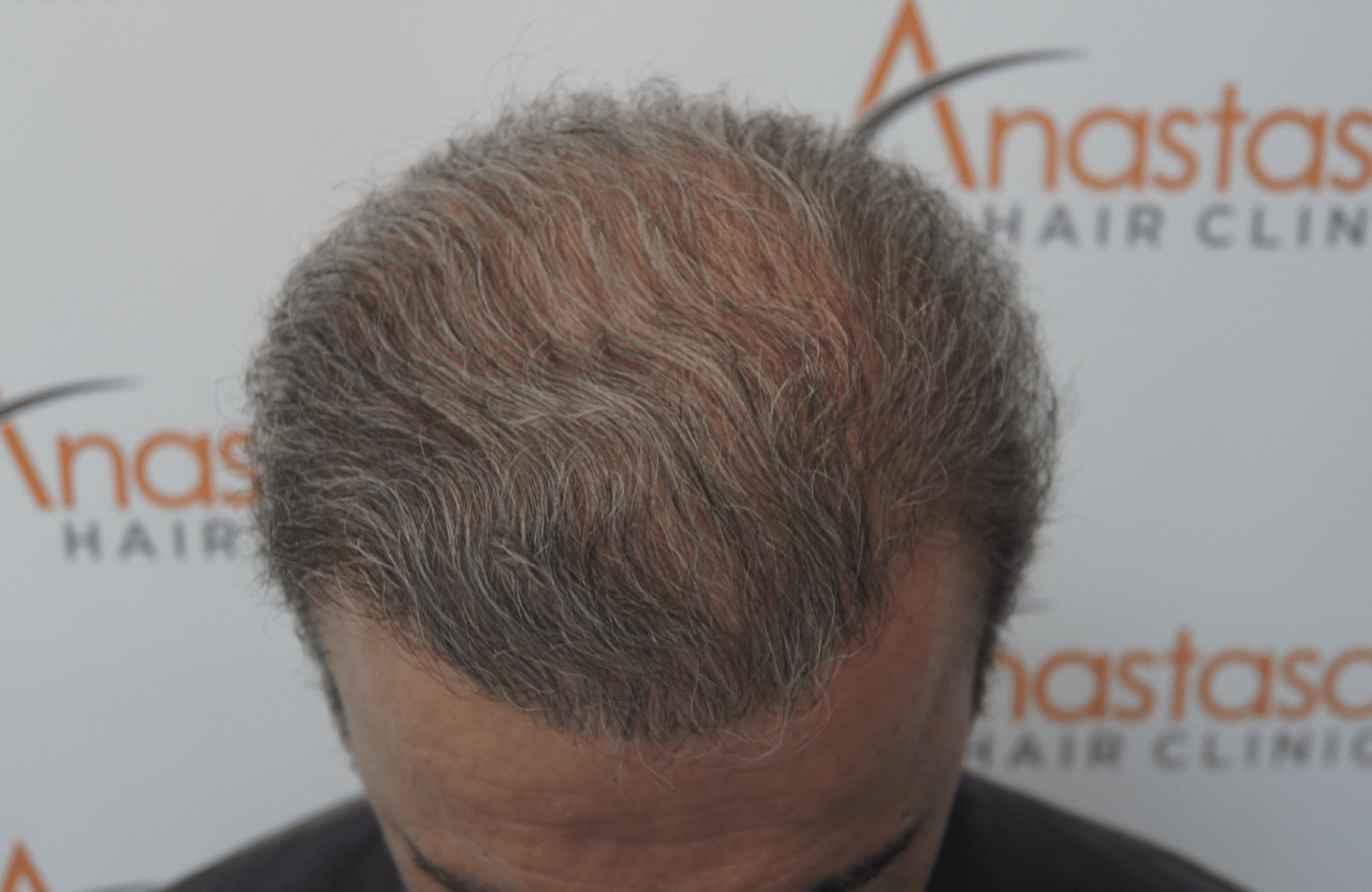 hair transplant result - repair session with 3000 fus after - frontal