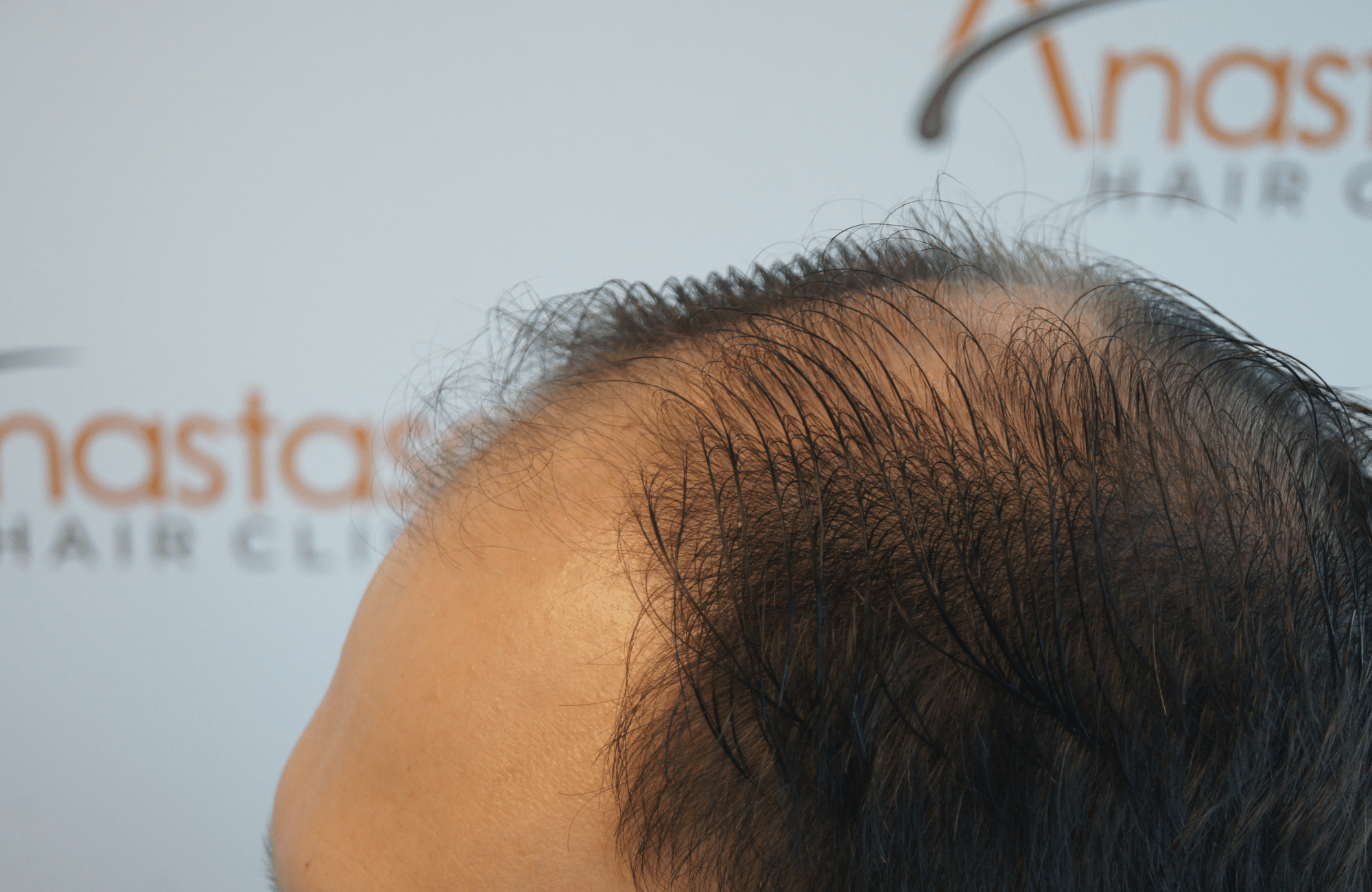 hair transplant patient result with 2700 fus before - side2