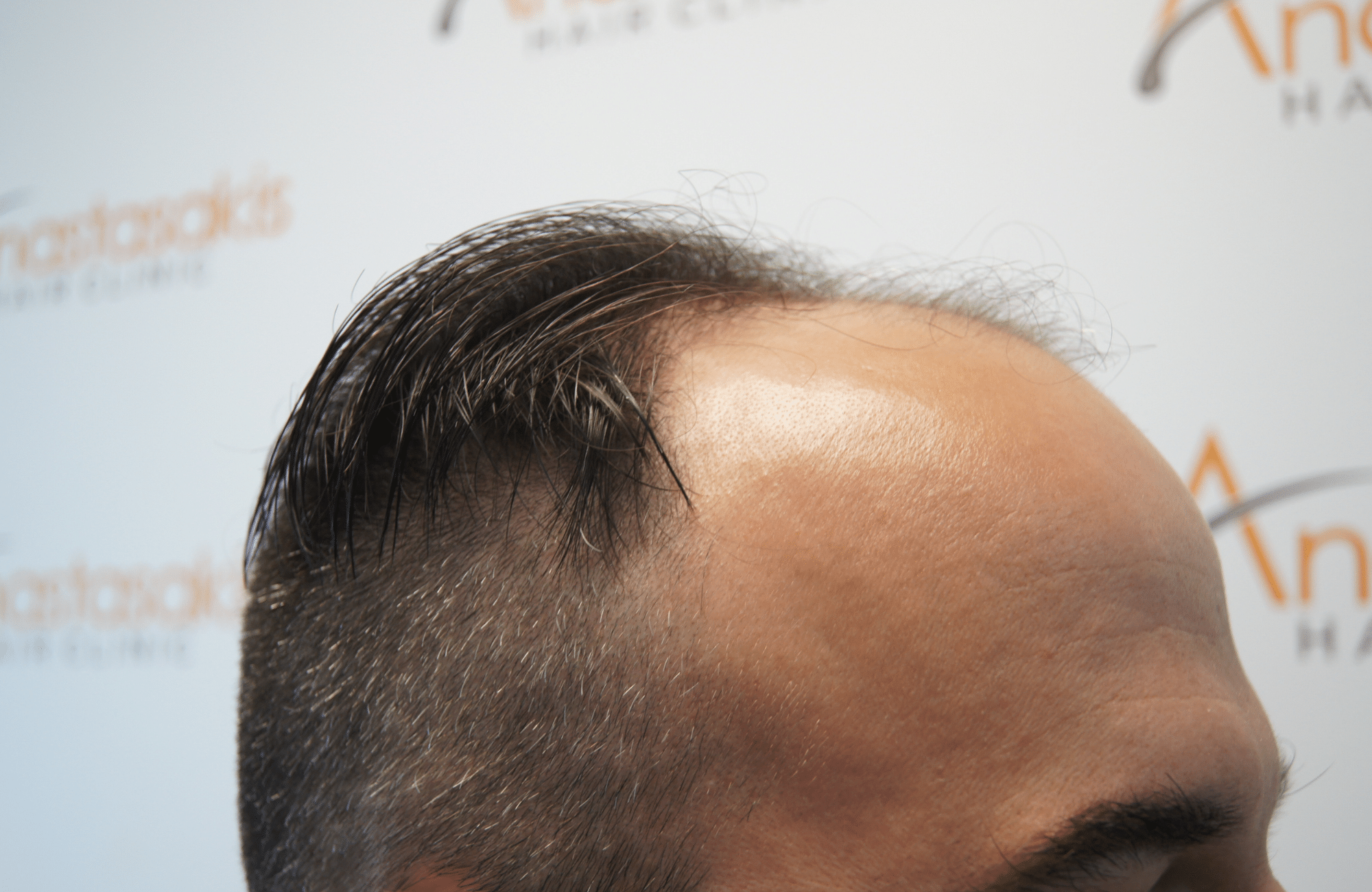 hair transplant patient result with 2500 fus before - side1