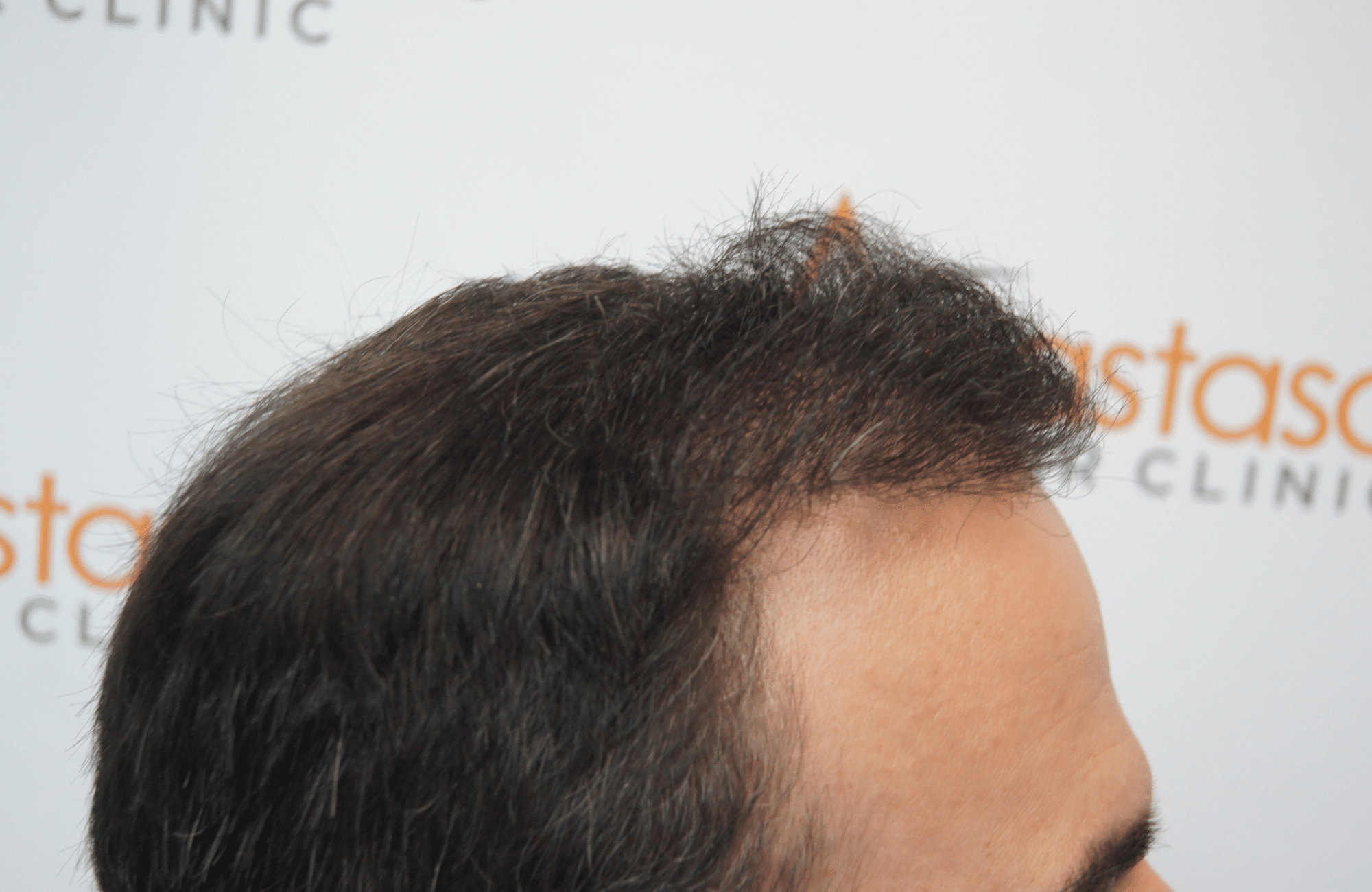 hair transplant patient result with 2500 fus after - side1