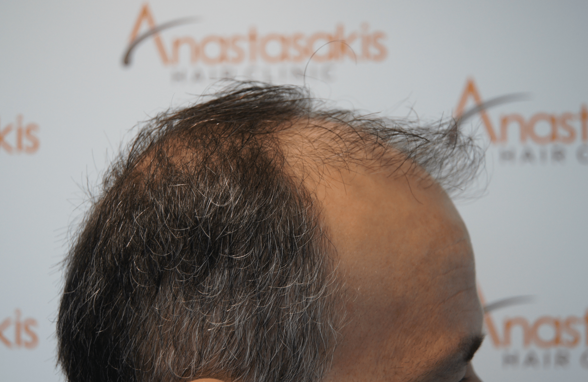 hair transplant patient result with 3500 fus before - side2