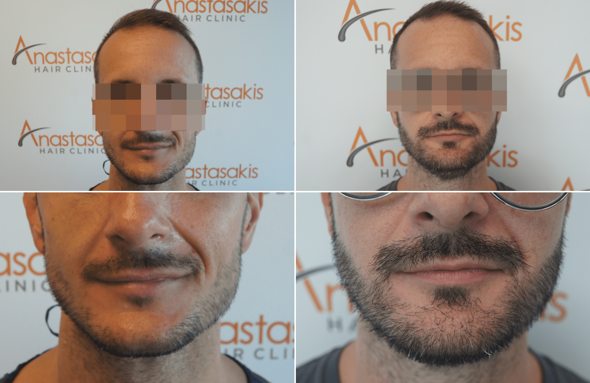 https://anastasakishairclinic.com/portfolio/apotelesma-metamosxefsis-mallion-anastasakis-hair-clinic-408/