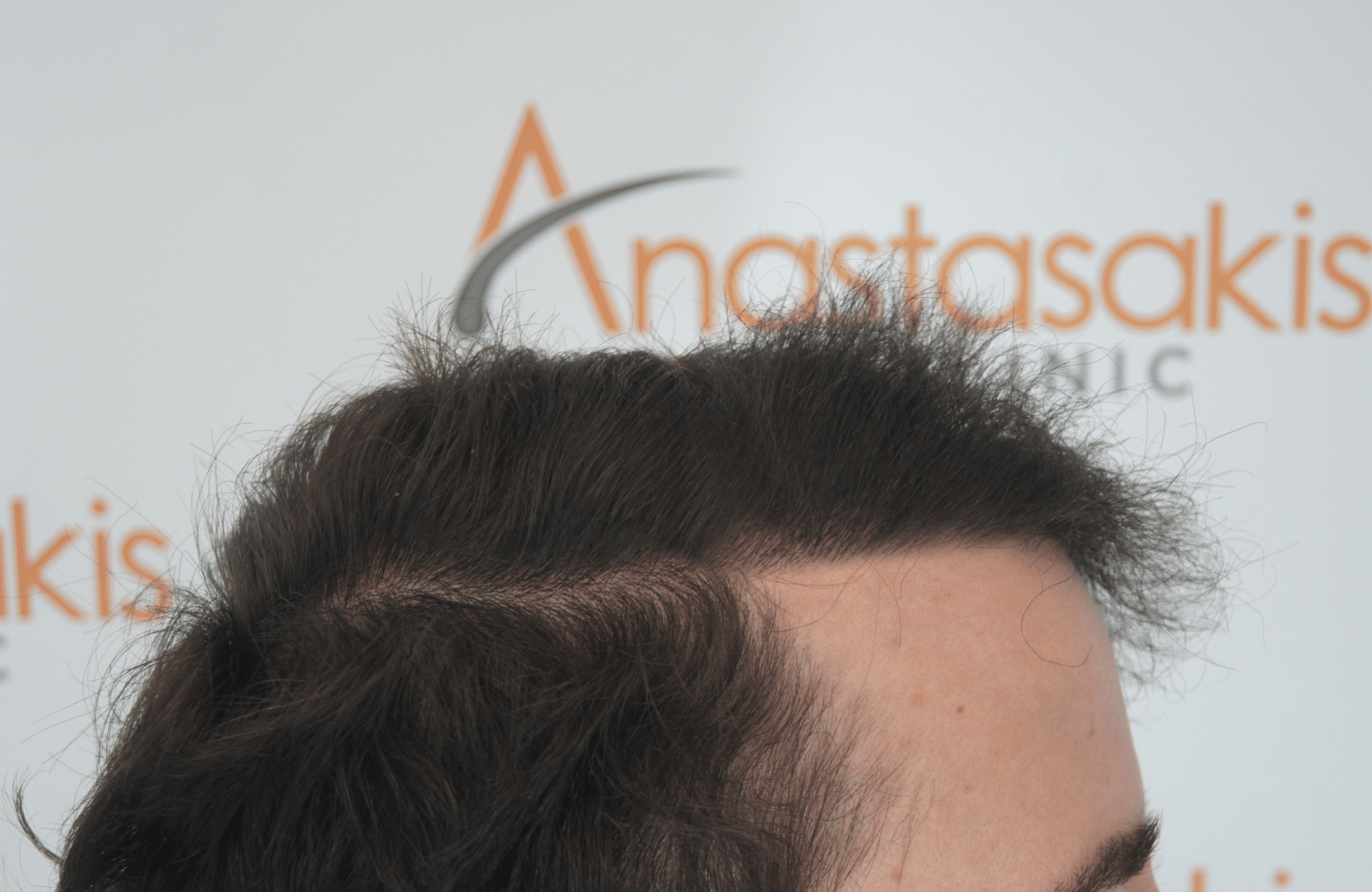 hair transplant result with 2500 fus after - side3