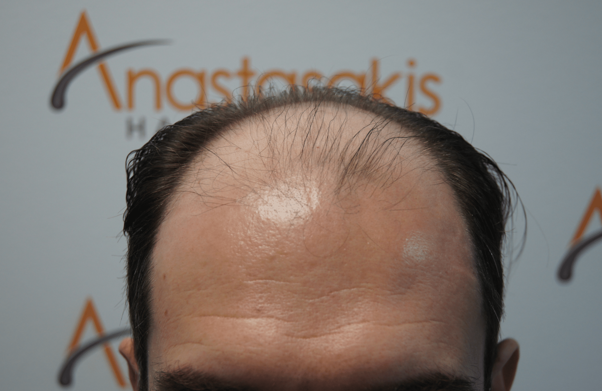 hair transplant result with 3500 fus before - hairline