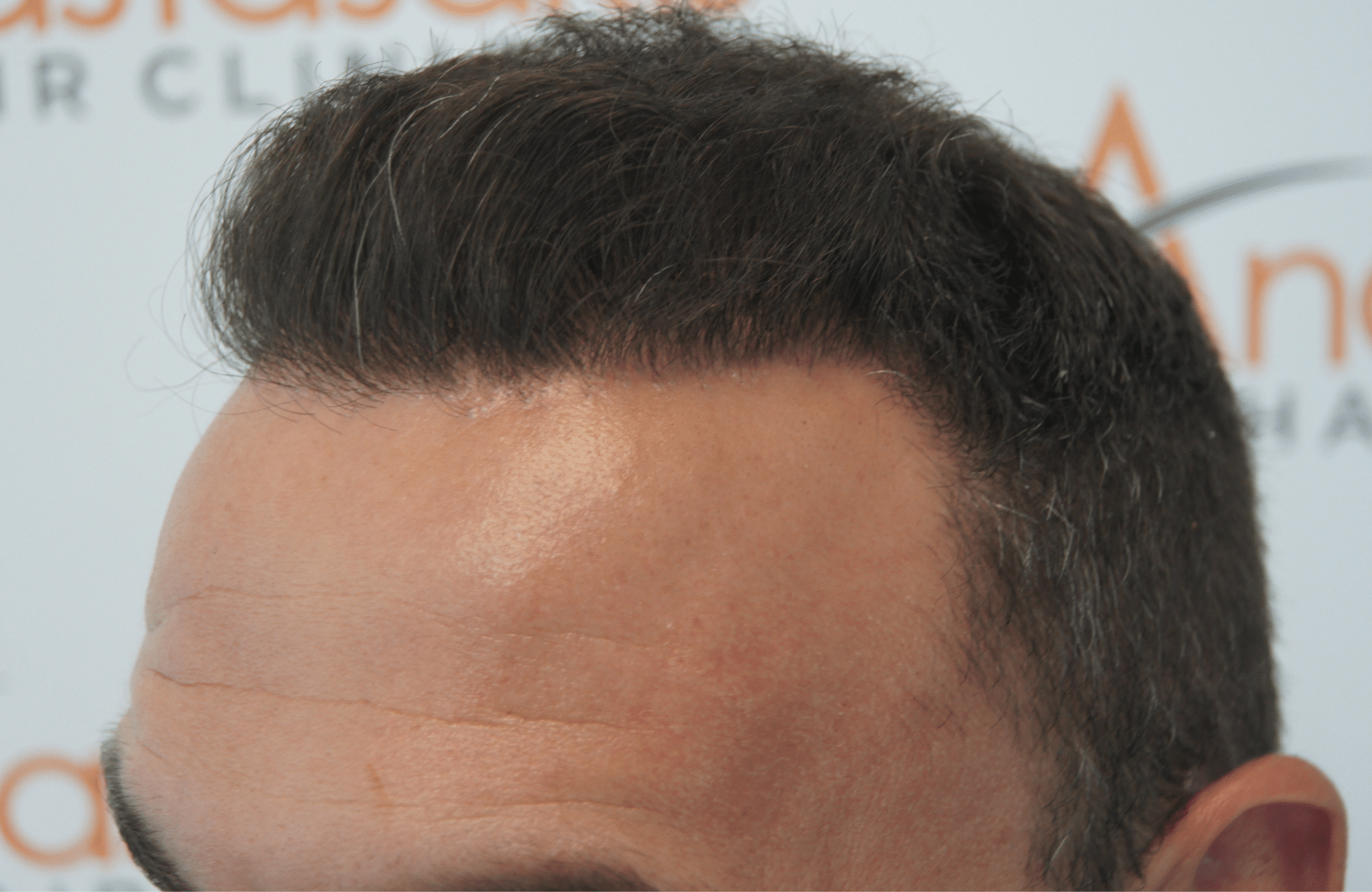 hair transplant result with 3500 fus after- side3