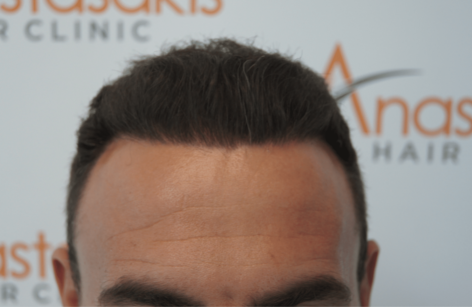 hair transplant result with 3500 fus after- hairline