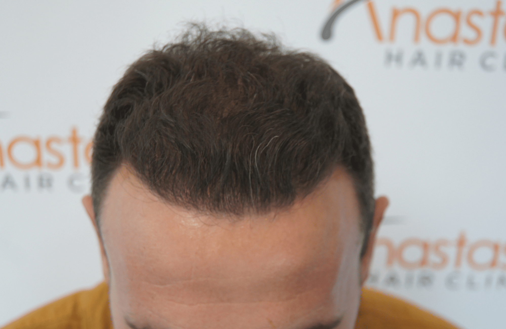 hair transplant result with 3500 fus after- frontal