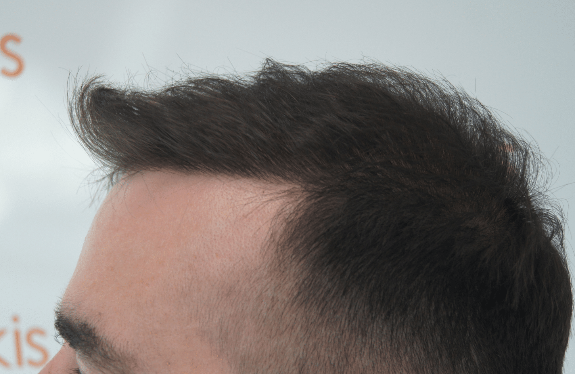 12 months after hair transplant with 2000 fus - side1