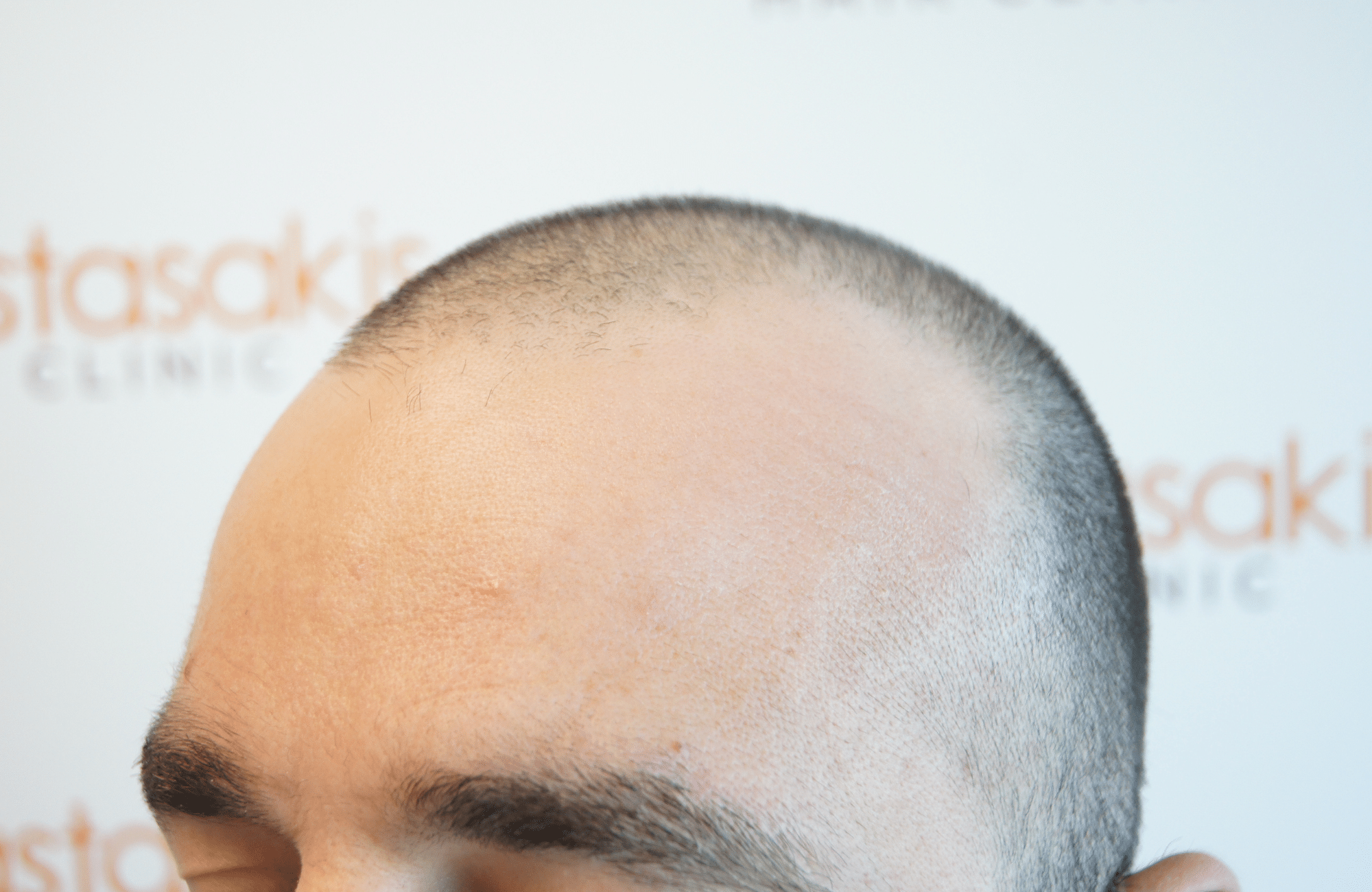 before hair transplant with 2000 fus - side3